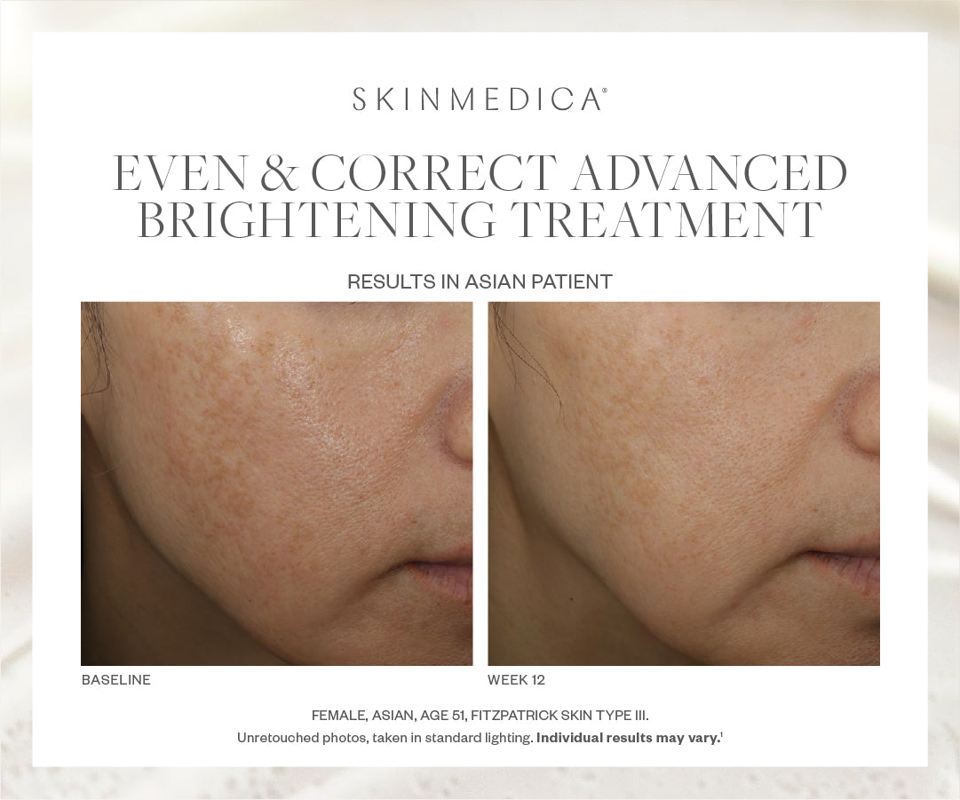 SkinMedica Even & Correct Advanced Brightening Treatment Serum (1.7 oz).