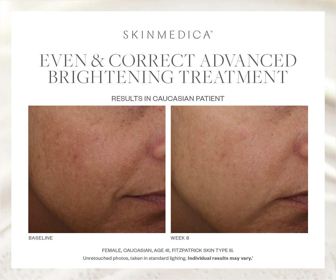 SkinMedica Even & Correct Advanced Brightening Treatment Serum (1.7 oz).