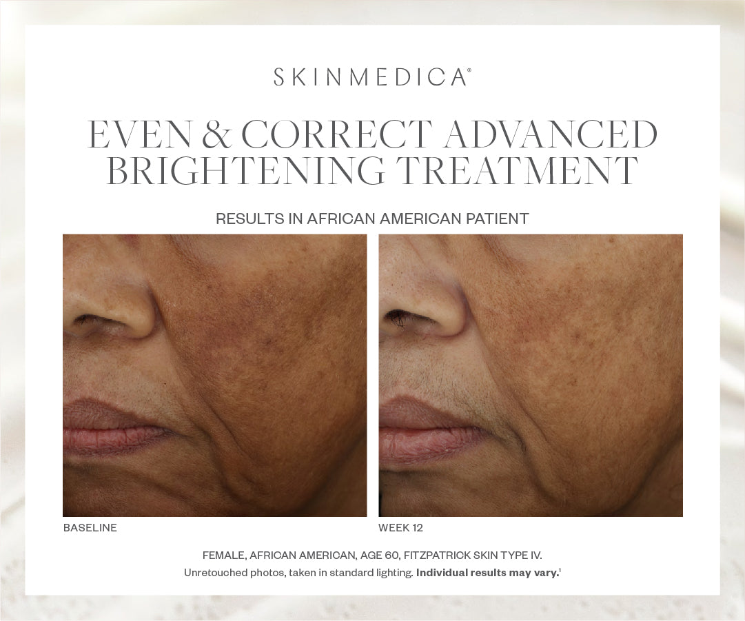 SkinMedica Even & Correct Advanced Brightening Treatment Serum (1.7 oz).