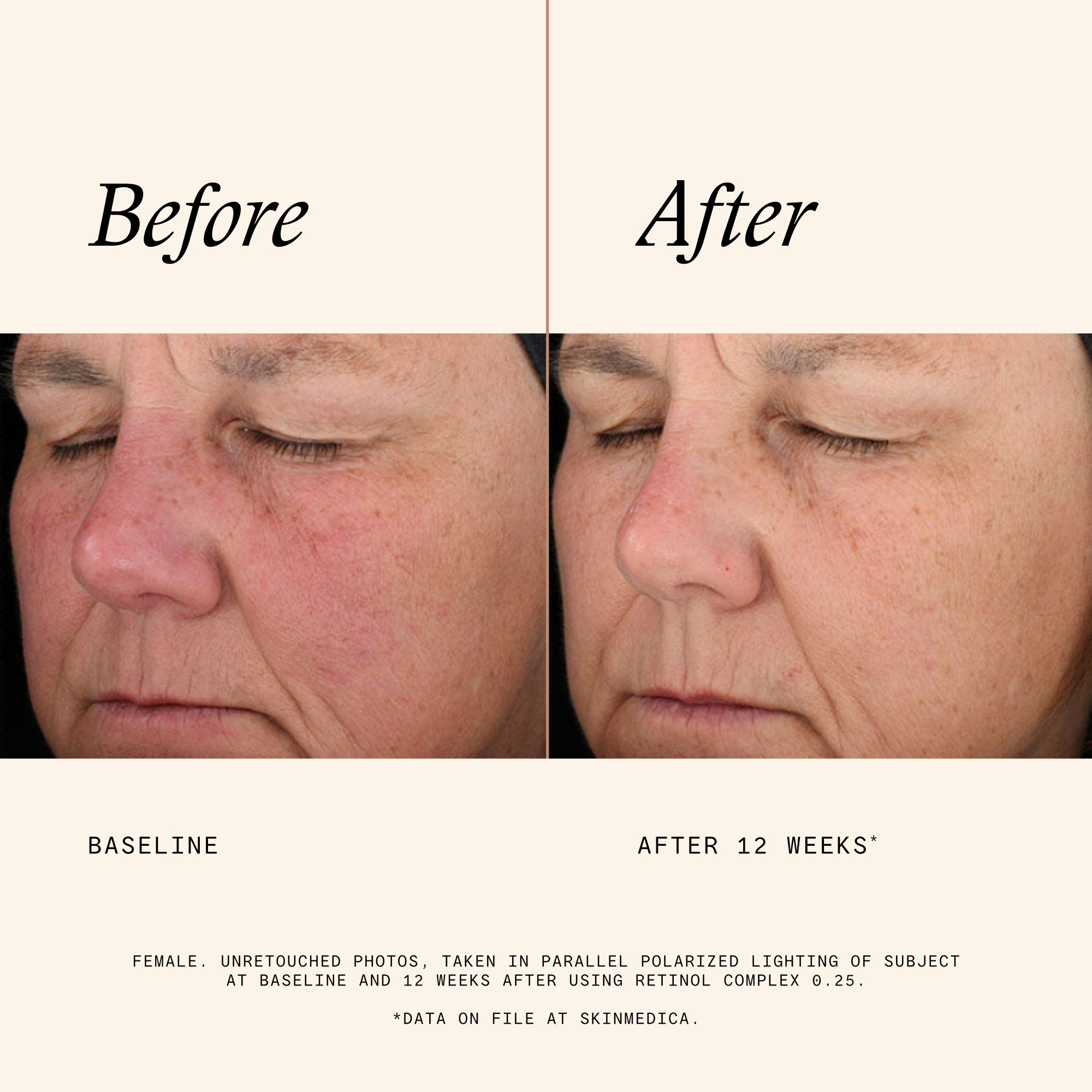 SkinMedica Retinol Complex 0.25 (1 oz).