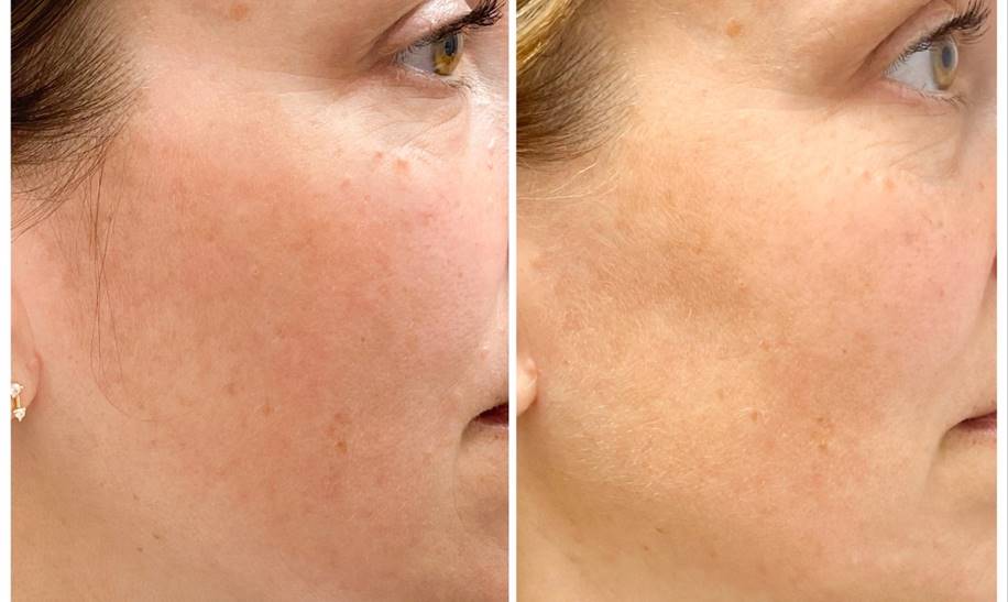 ISDIN Isdinceutics Melaclear Advanced Serum (1.7 oz)