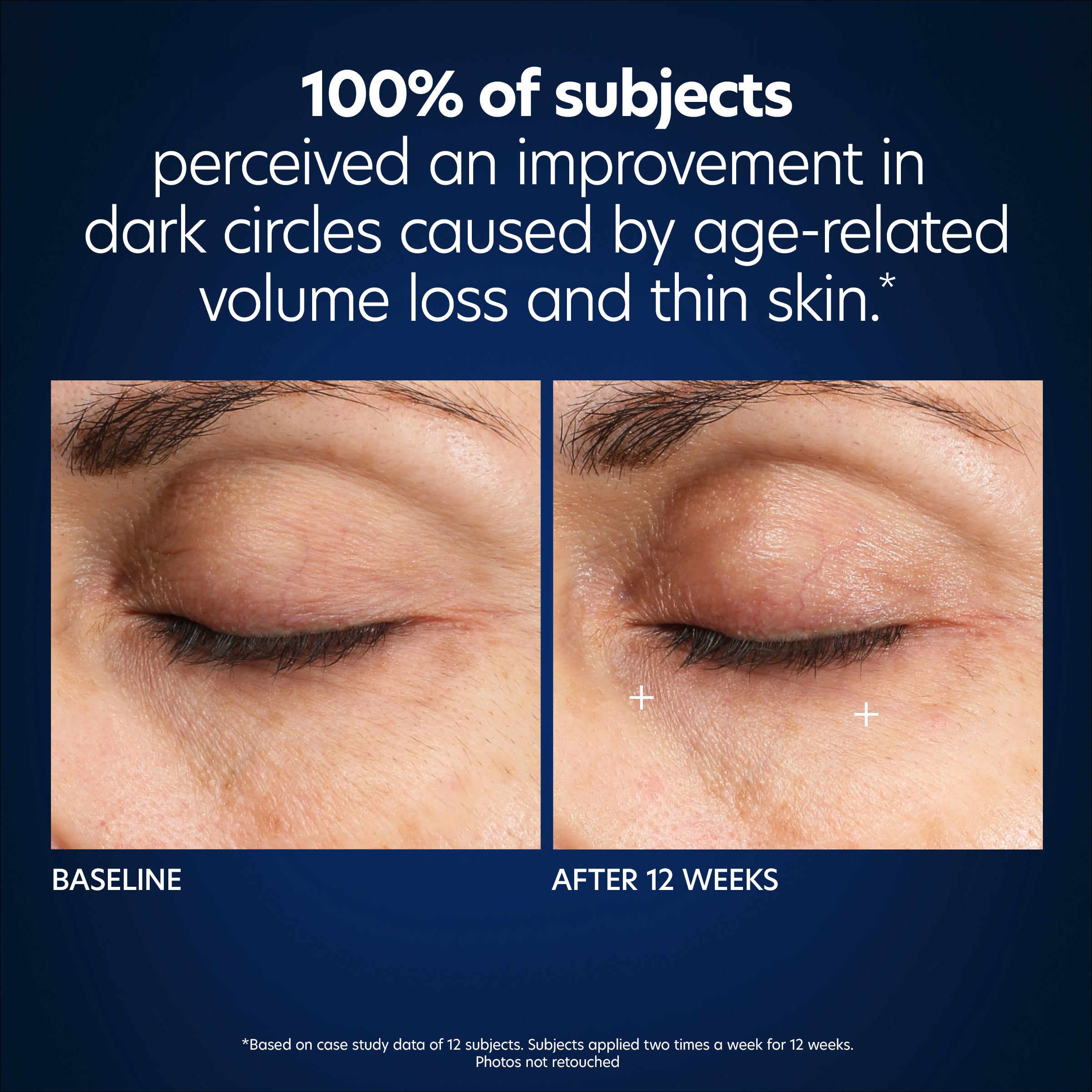 PCA Skin Hyaluronic Acid Microneedle Eye Patches (4 Count).