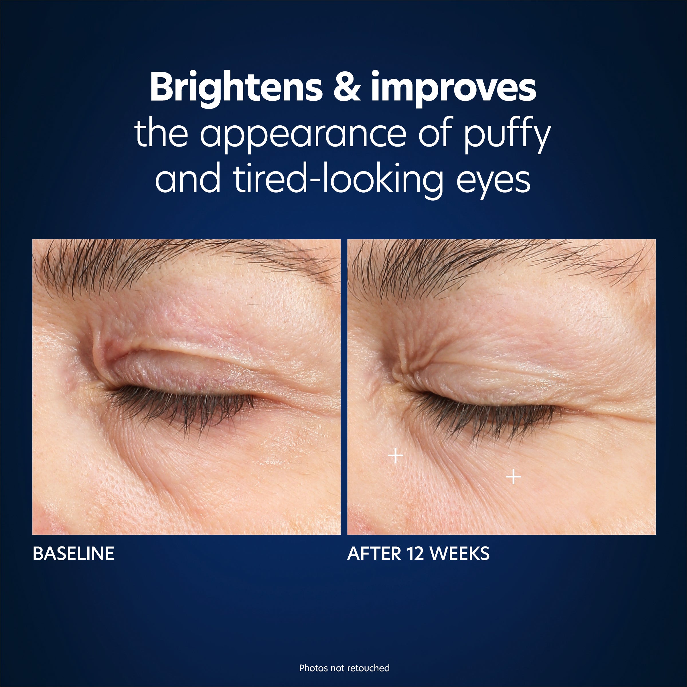 PCA Skin Hyaluronic Acid Microneedle Eye Patches (4 Count).