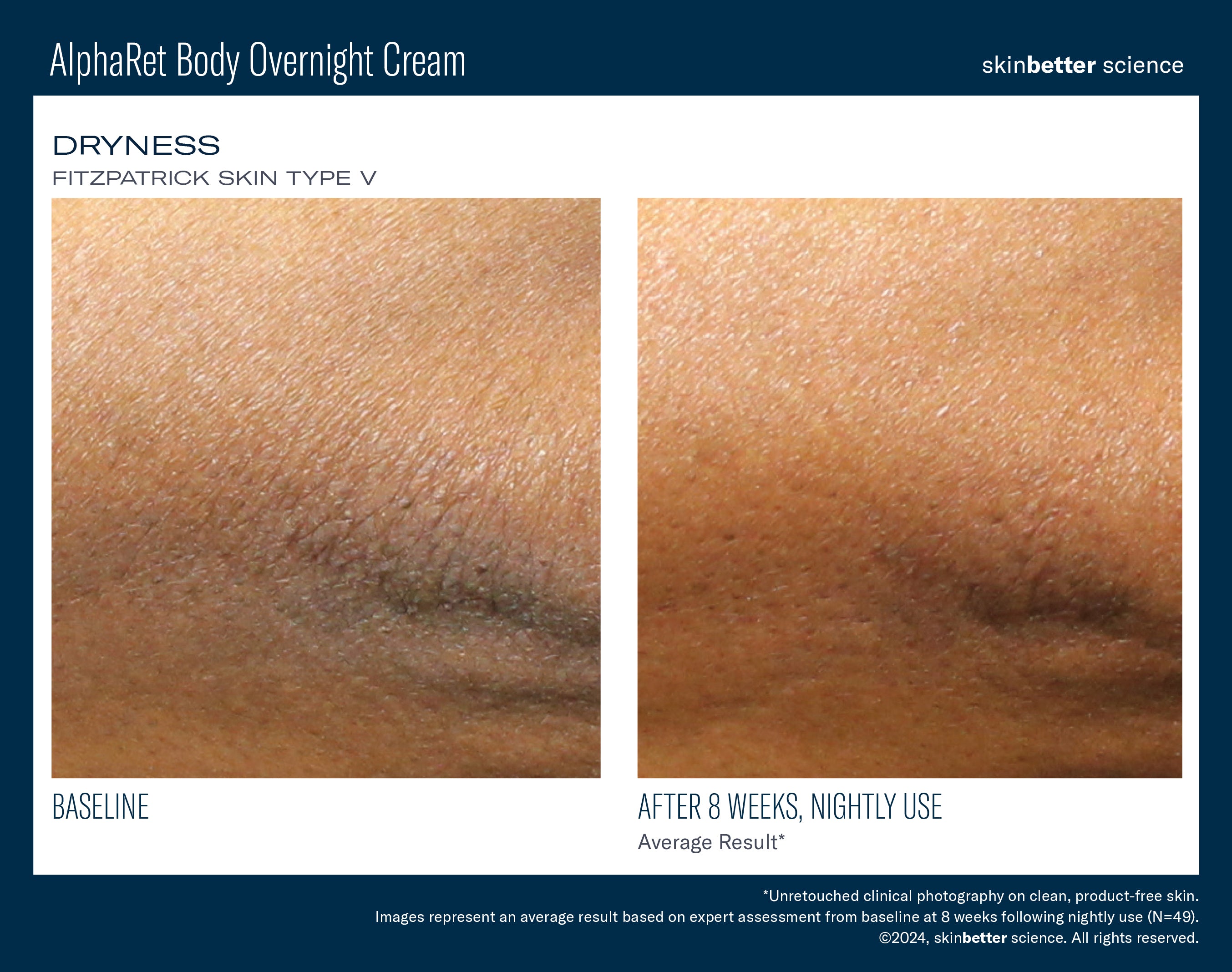 SkinBetter Science AlphaRet Body Overnight Cream (5 oz).
