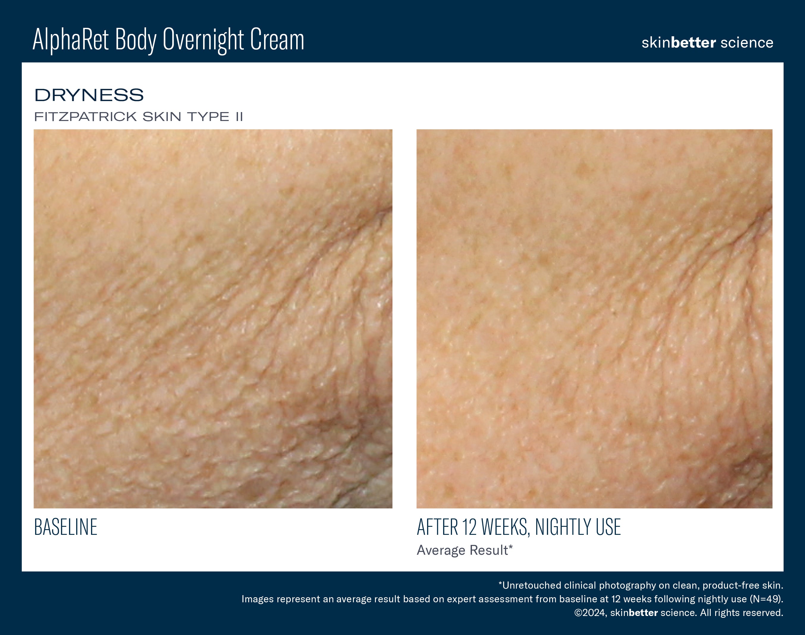 SkinBetter Science AlphaRet Body Overnight Cream (5 oz).