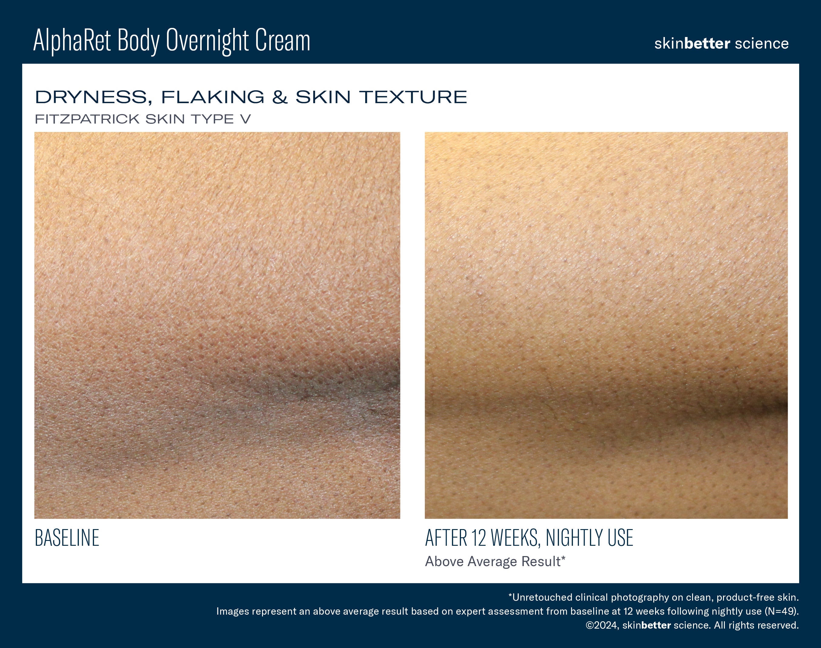 SkinBetter Science AlphaRet Body Overnight Cream (5 oz).