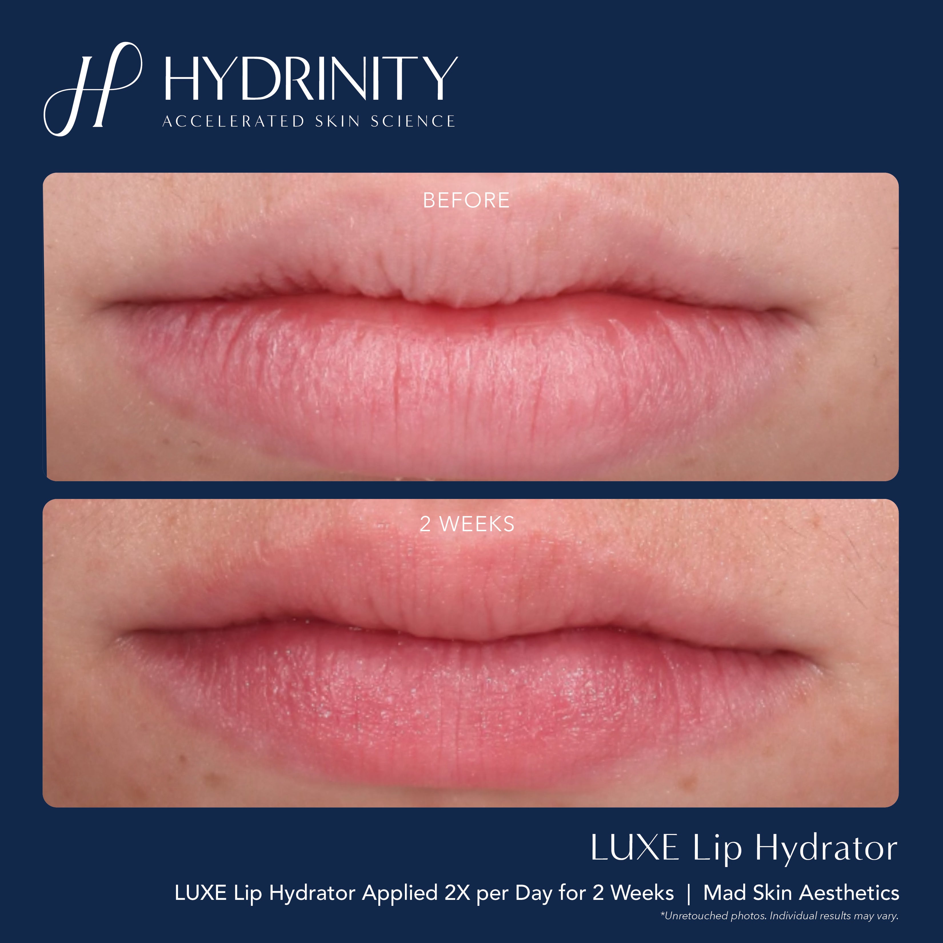 Hydrinity LUXE Lip Hydrator (0.34 oz)