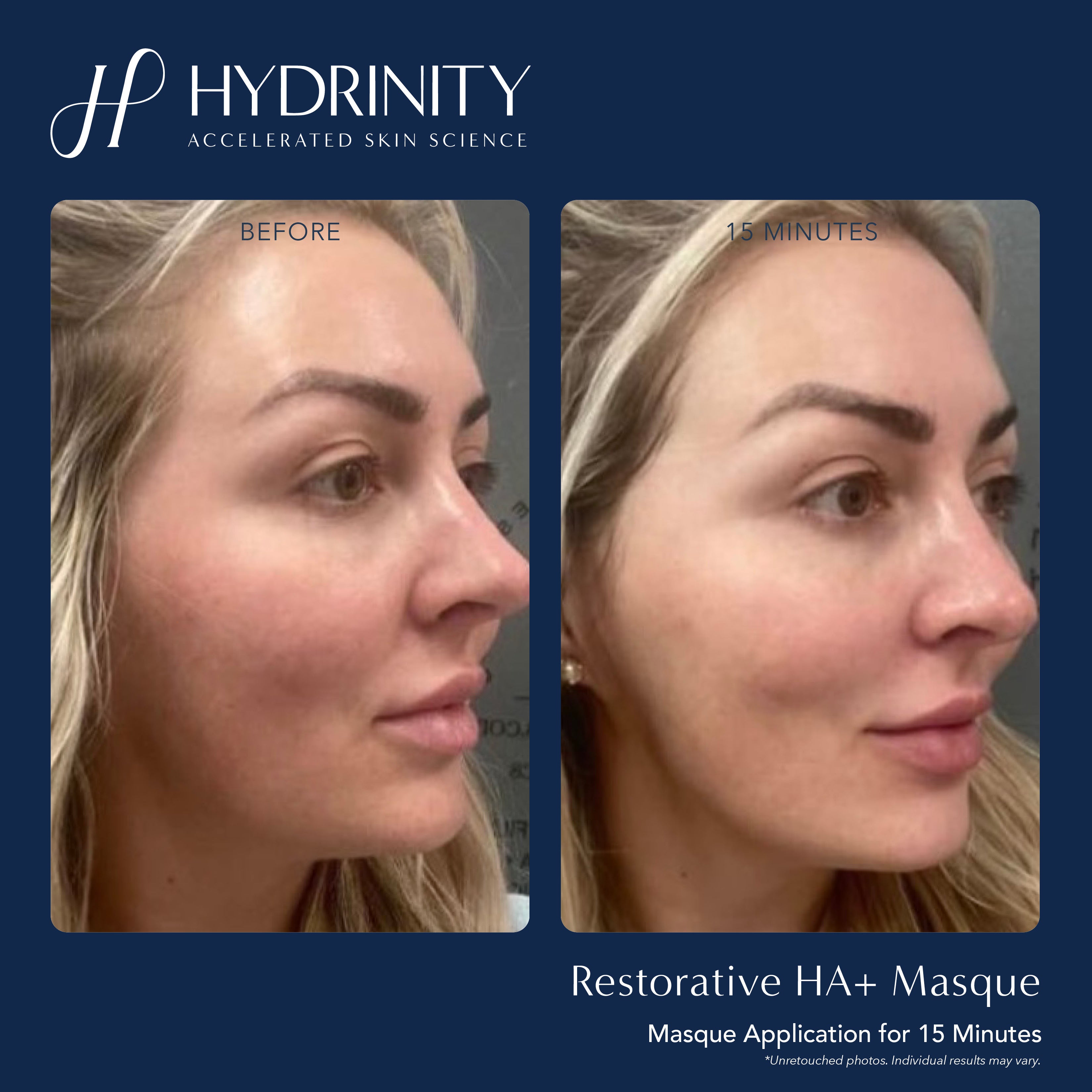 Hydrinity Restorative HA+ Masque (5 Count)