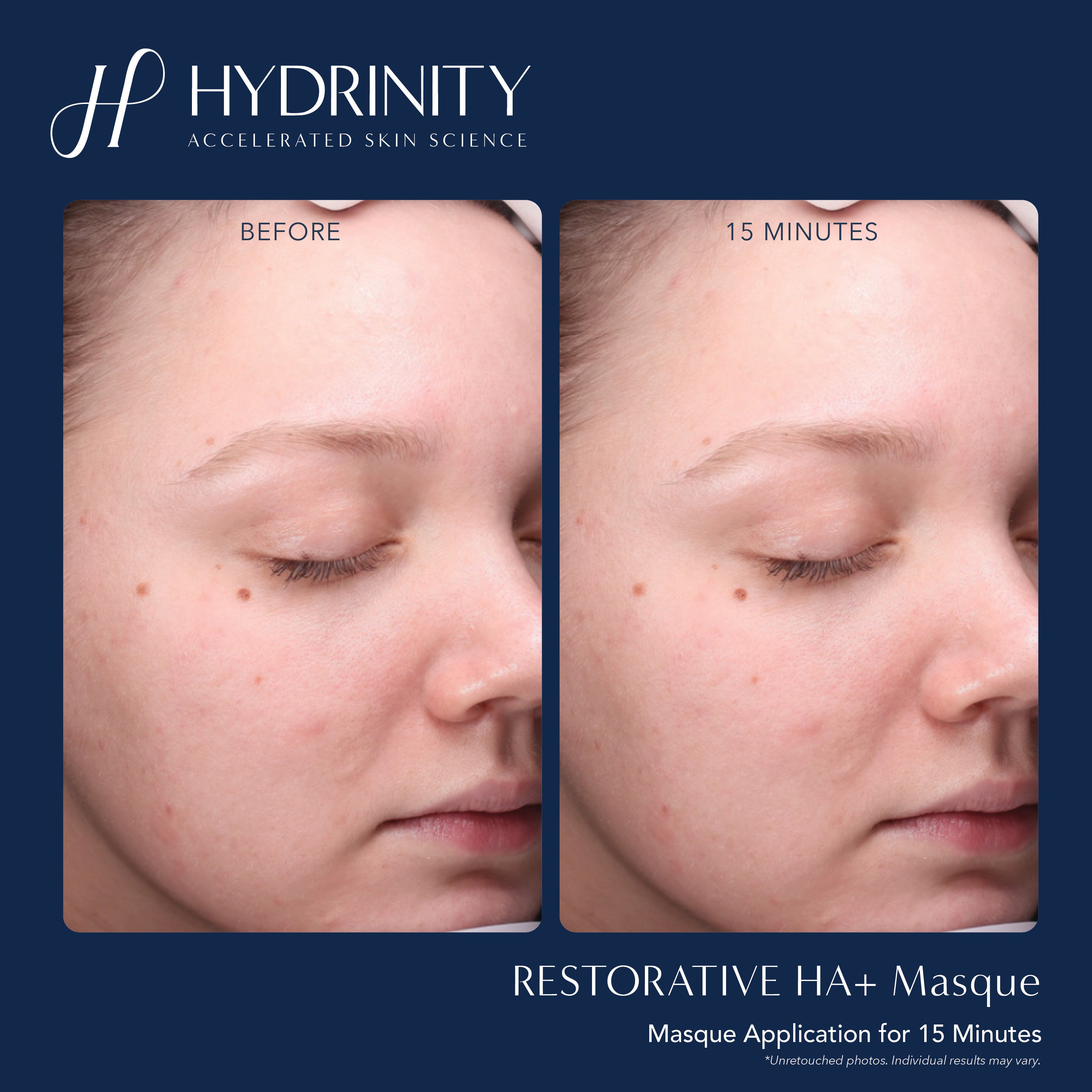Hydrinity Restorative HA+ Masque (5 Count)
