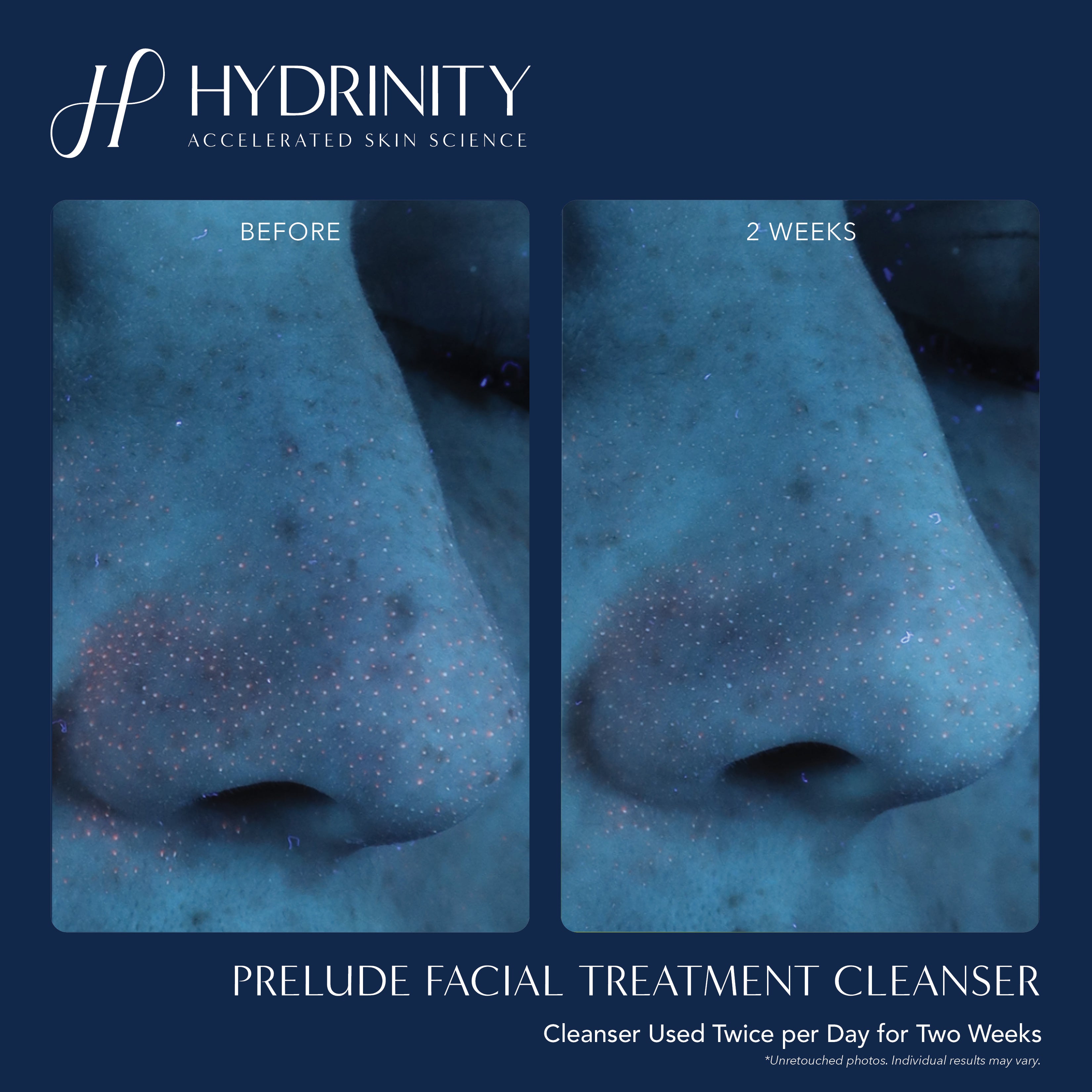 Hydrinity PRELUDE Facial Treatment Cleanser (6 oz)