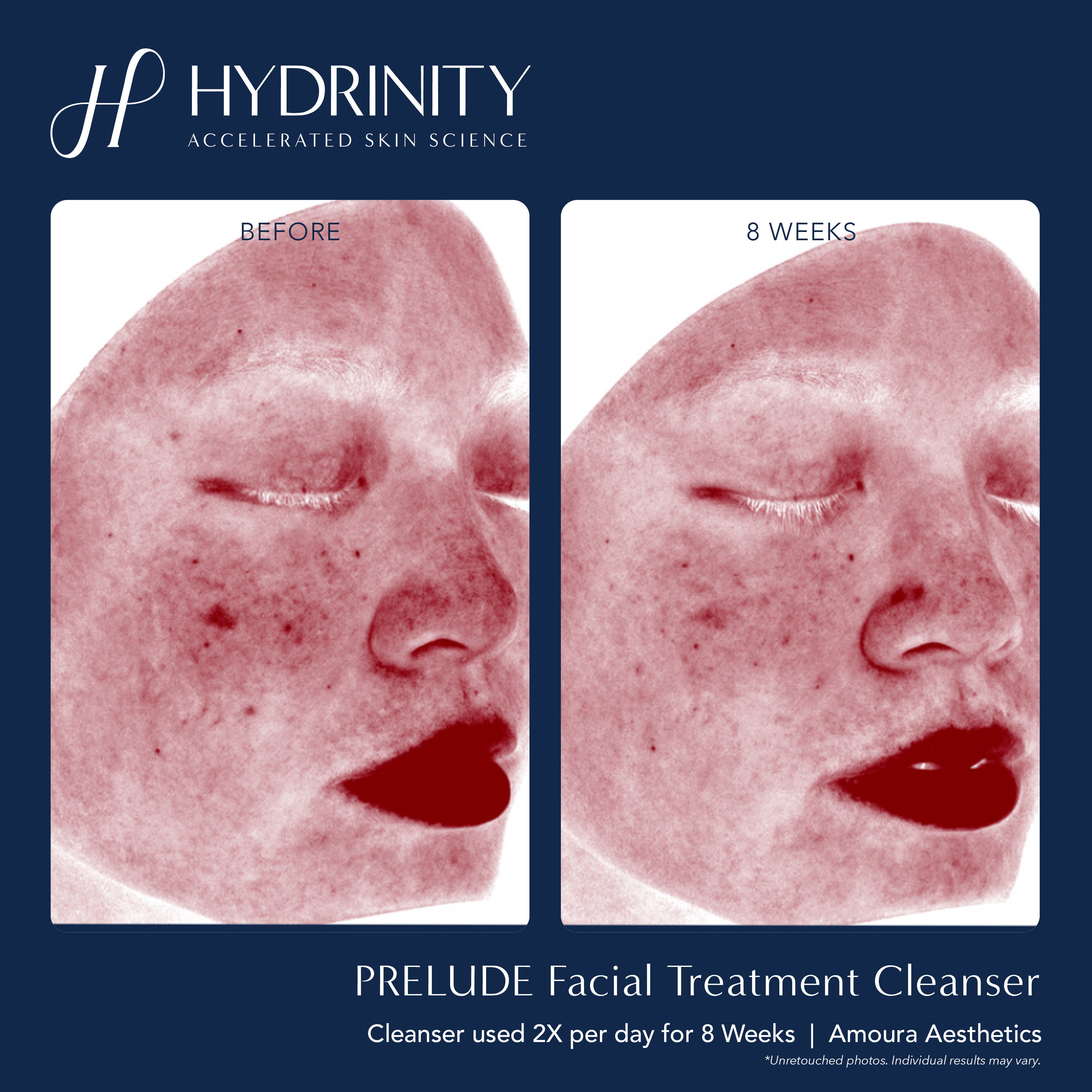 Hydrinity PRELUDE Facial Treatment Cleanser (6 oz)