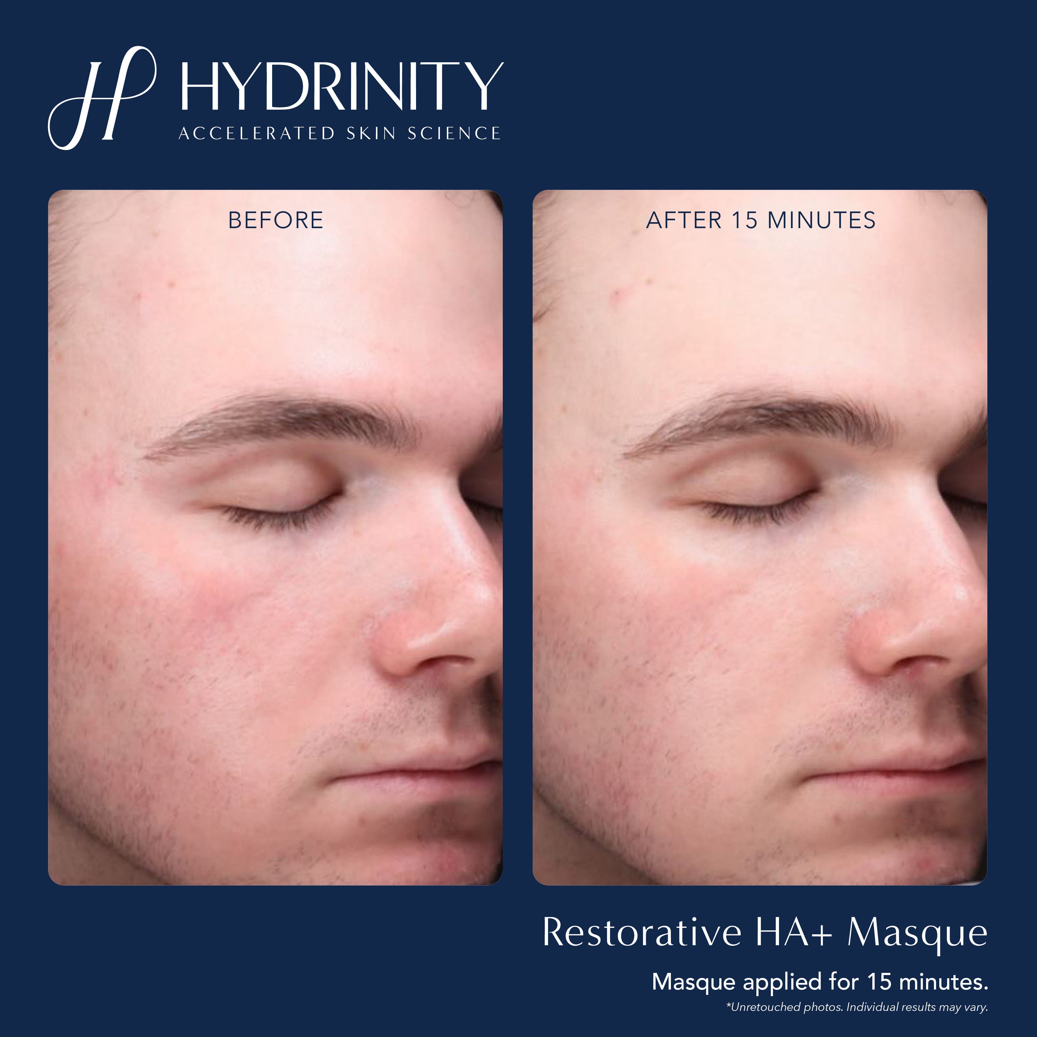 Hydrinity Restorative HA+ Masque (5 Count)