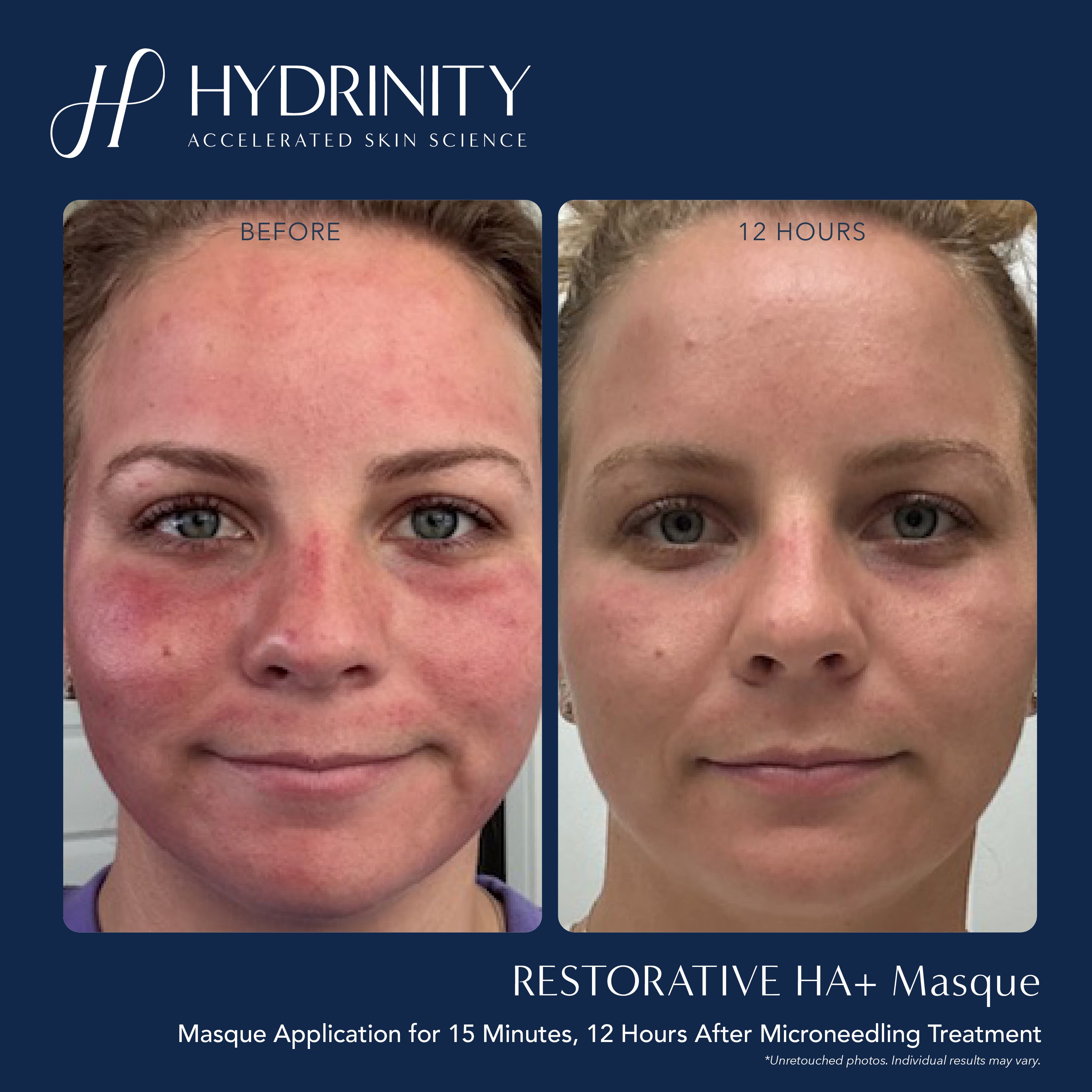 Hydrinity Restorative HA+ Masque (5 Count)