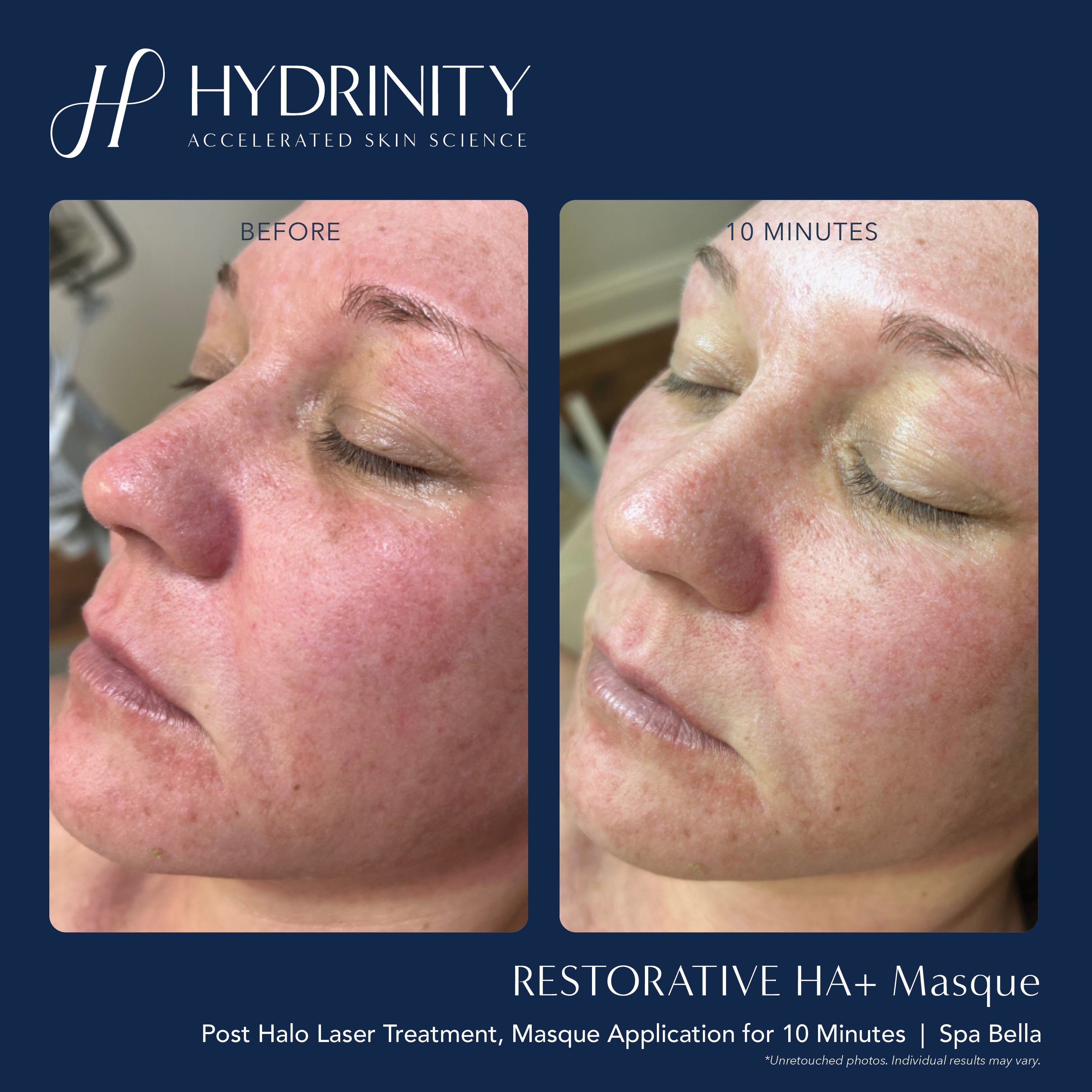 Hydrinity Restorative HA+ Masque (5 Count)