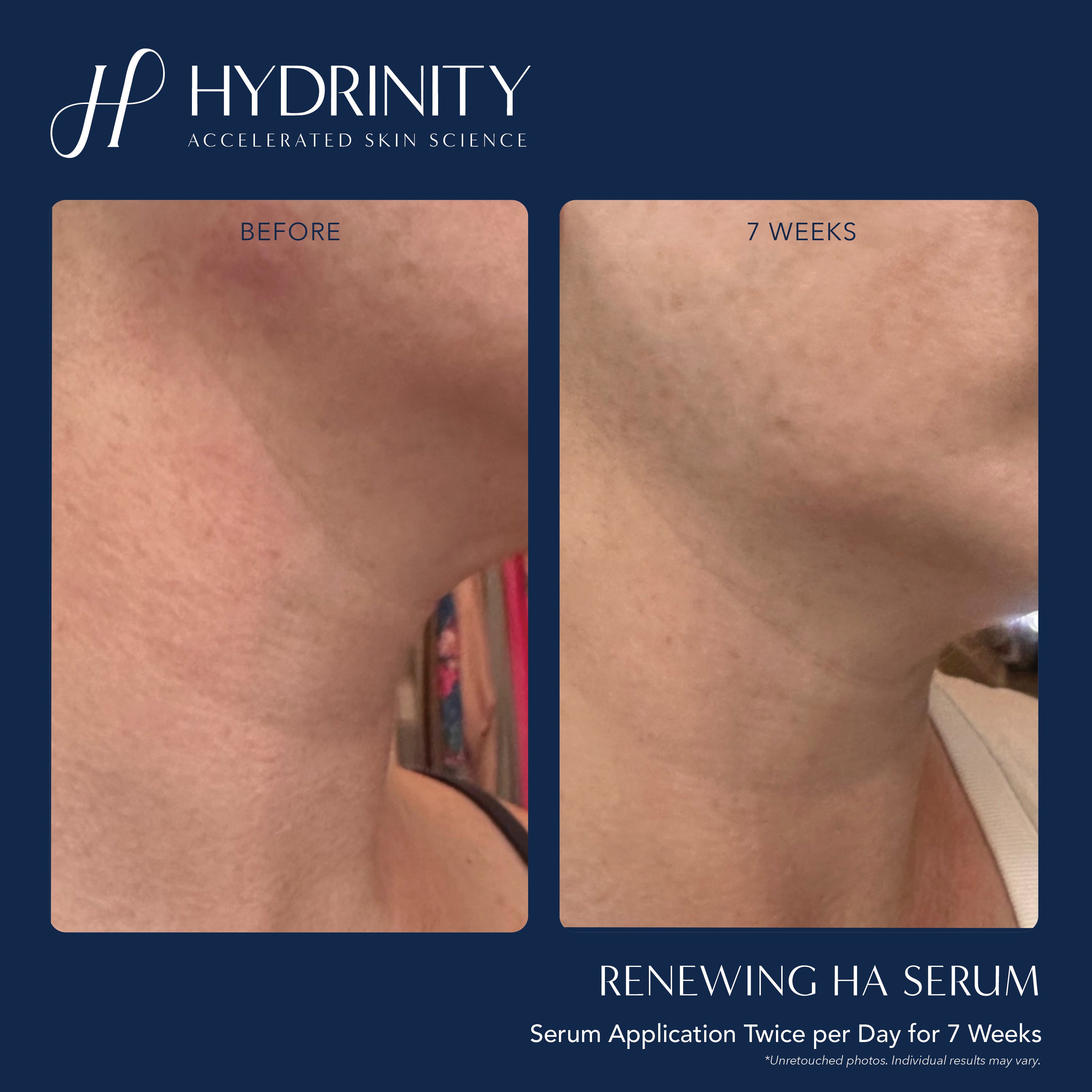 Hydrinity Renewing HA Serum (1 oz)