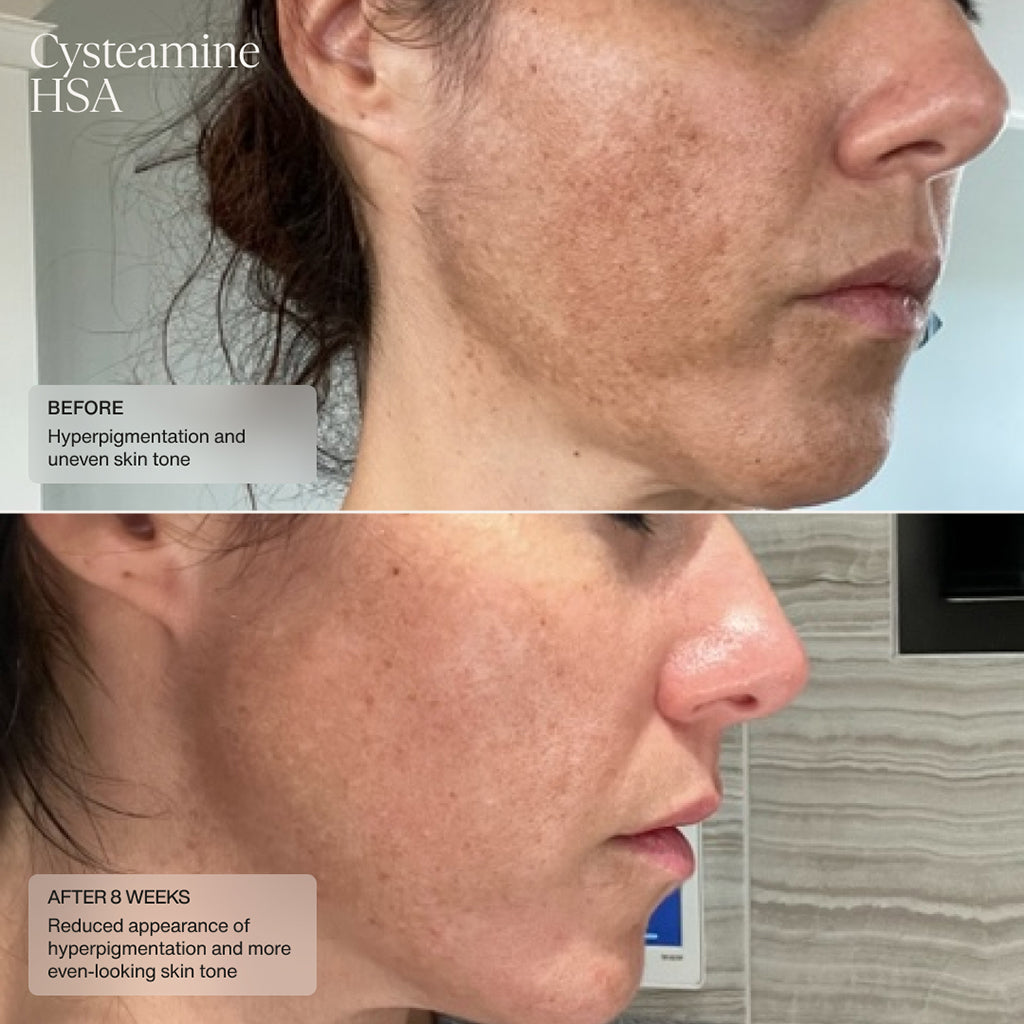 Senté Pigment & Tone Correcting Mask Cysteamine HSA (1.69 oz).