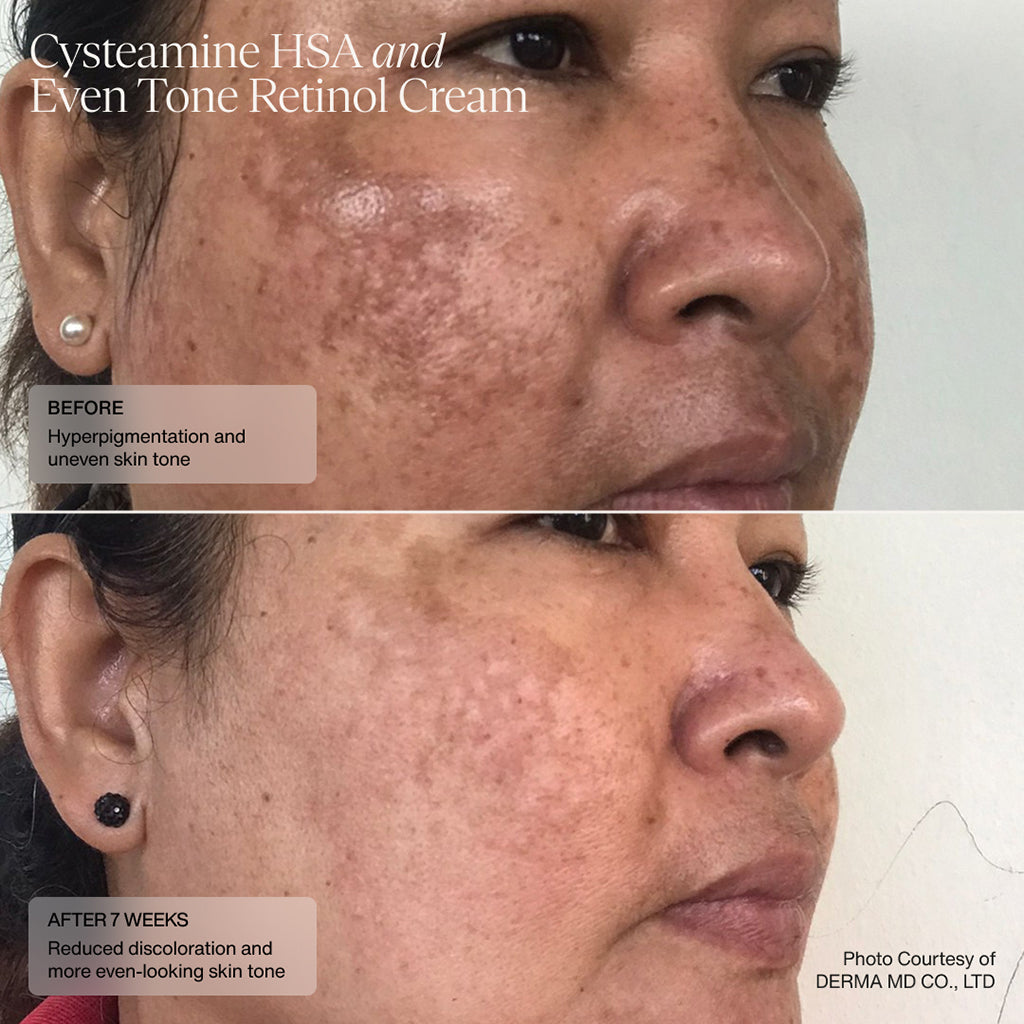 Senté Pigment & Tone Correcting Mask Cysteamine HSA (1.69 oz).