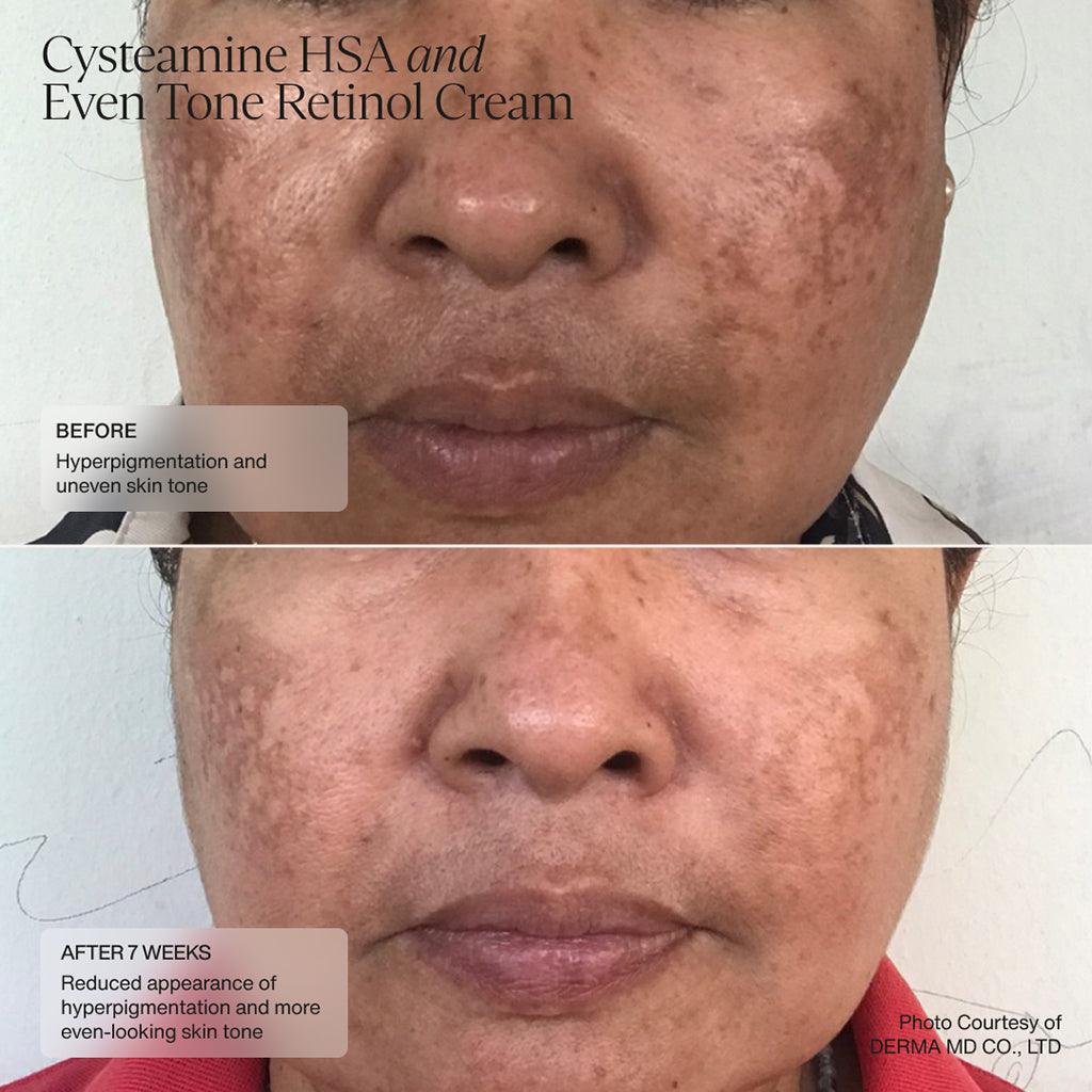 Senté Pigment & Tone Correcting Mask Cysteamine HSA (1.69 oz).
