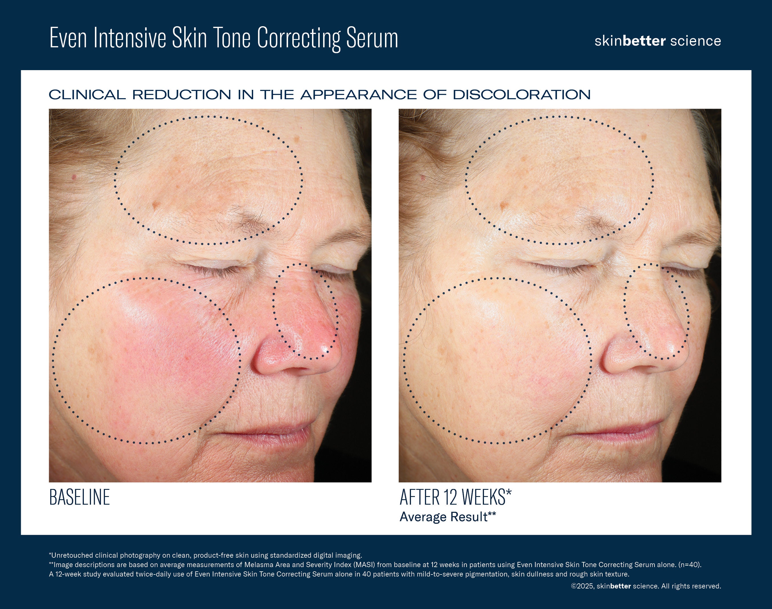 SkinBetter Science Even Intensive Skin Tone Correcting Serum (1.7 oz).