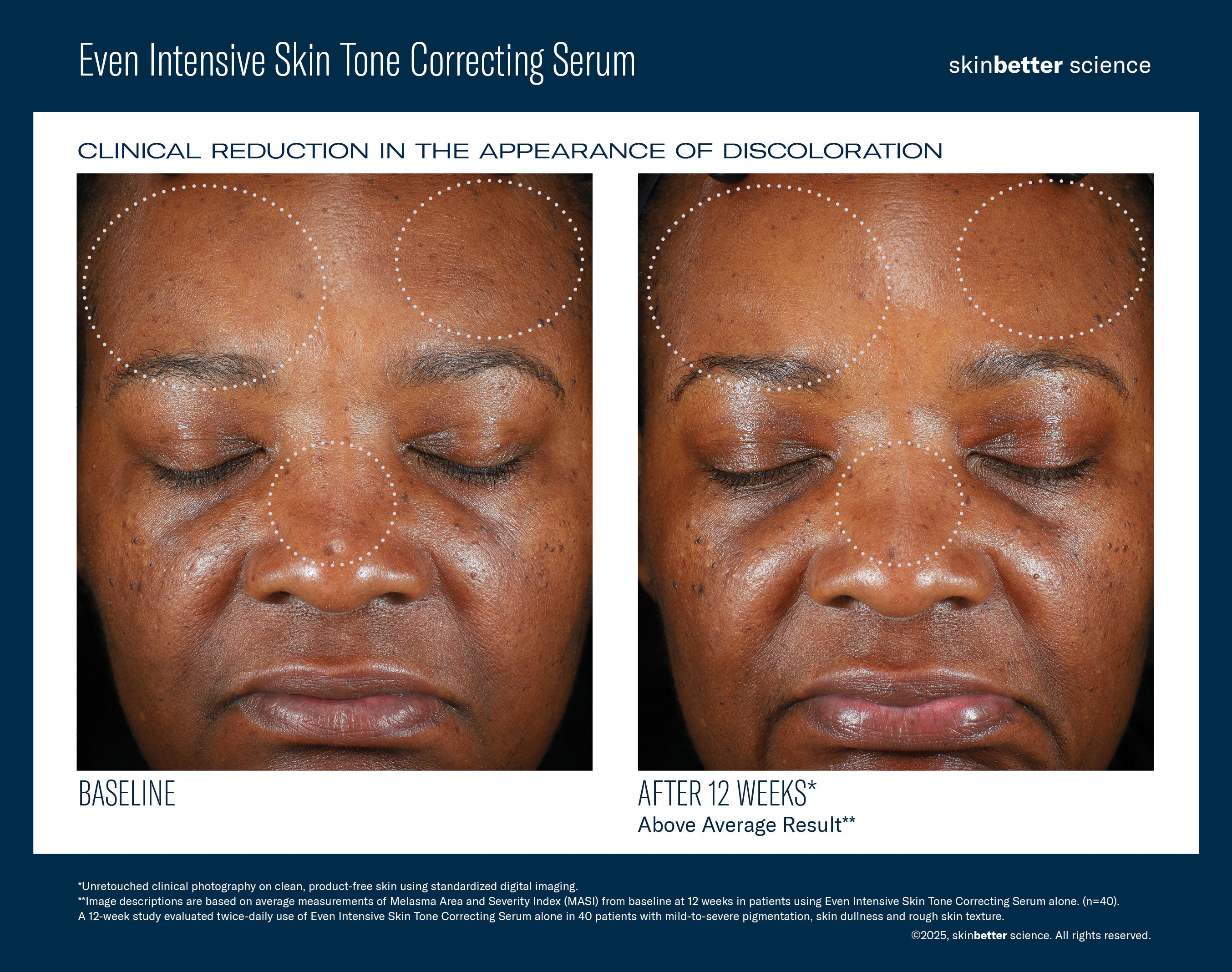 SkinBetter Science Even Intensive Skin Tone Correcting Serum (1.7 oz).