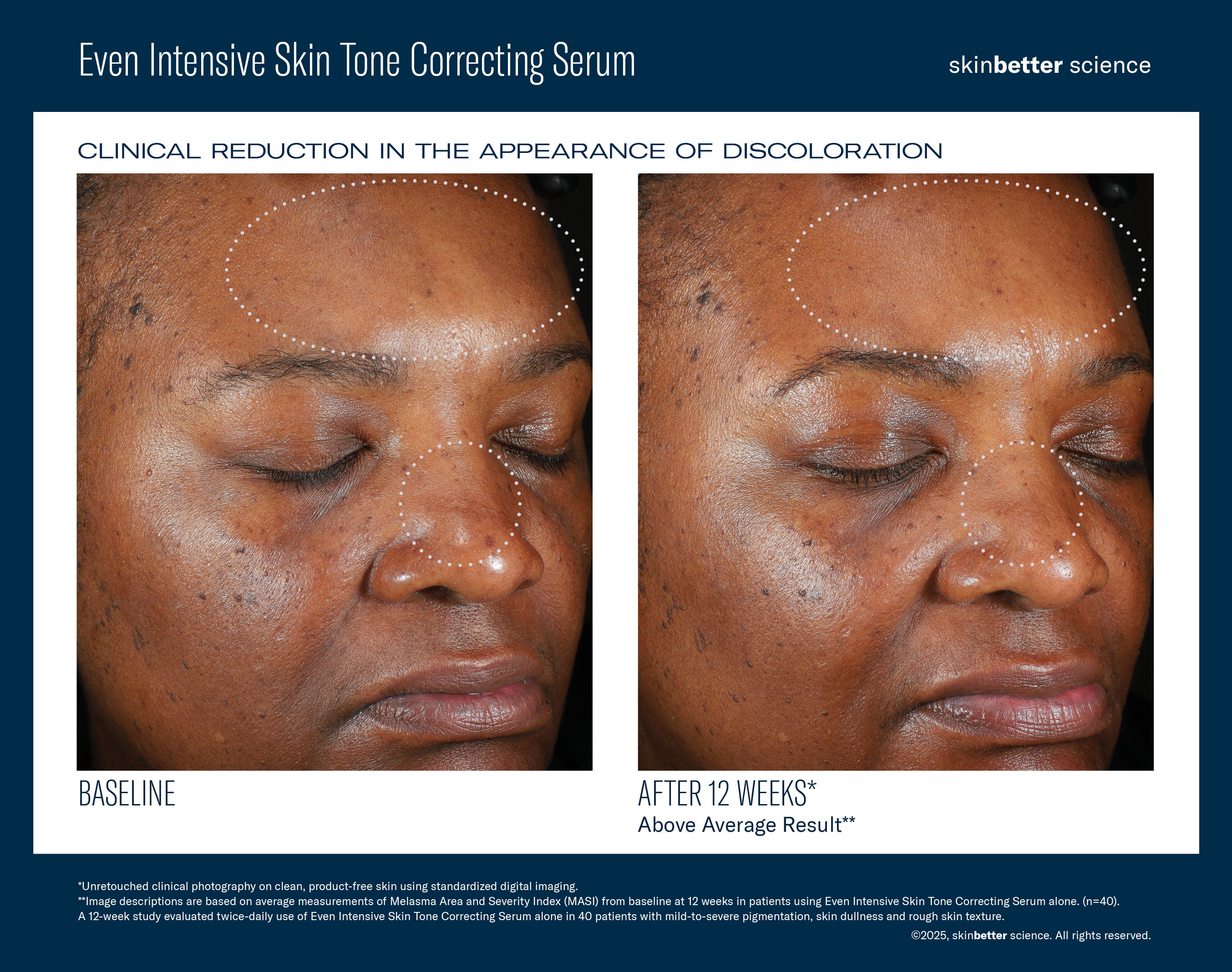 SkinBetter Science Even Intensive Skin Tone Correcting Serum (1.7 oz).