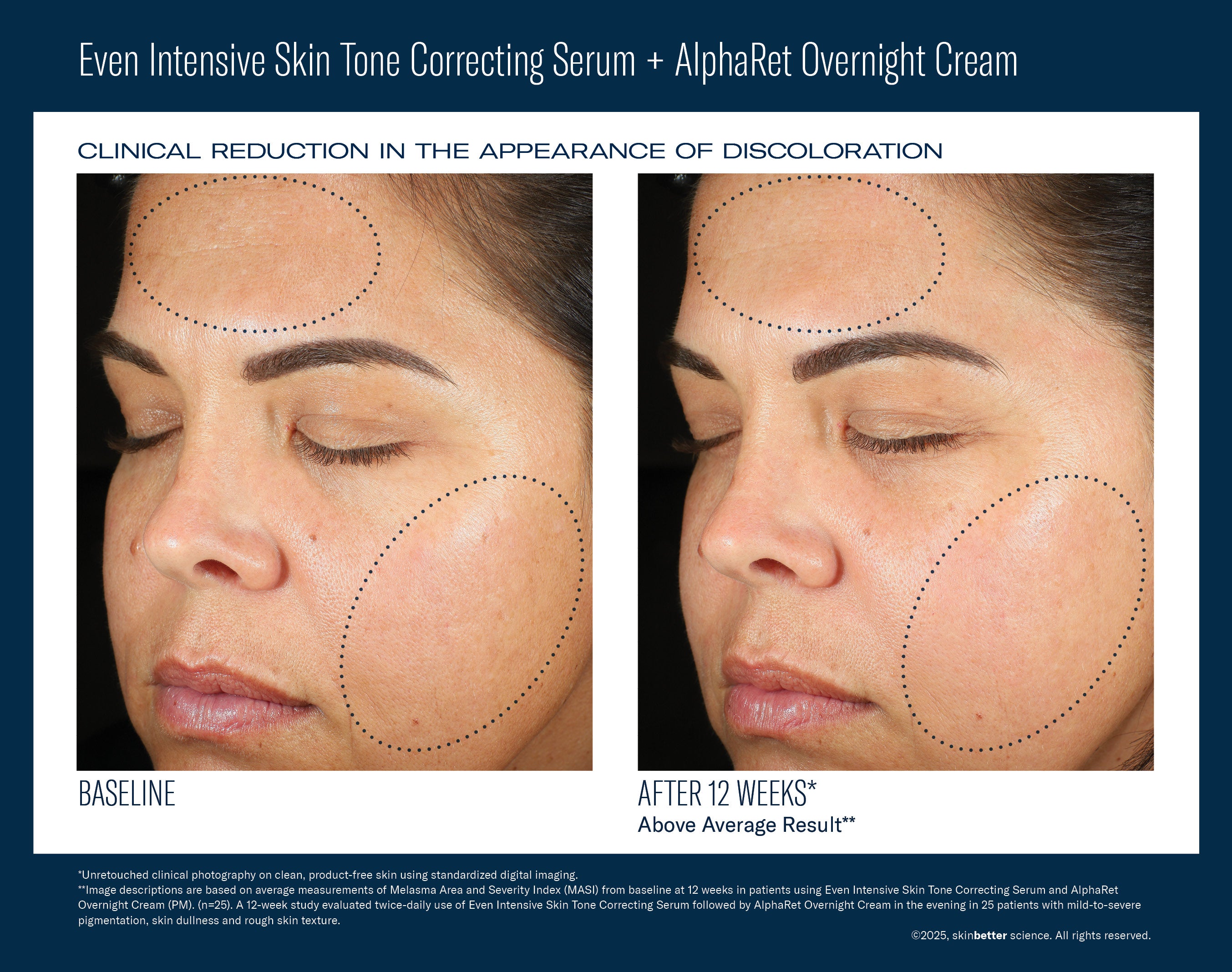 SkinBetter Science Even Intensive Skin Tone Correcting Serum (1.7 oz).