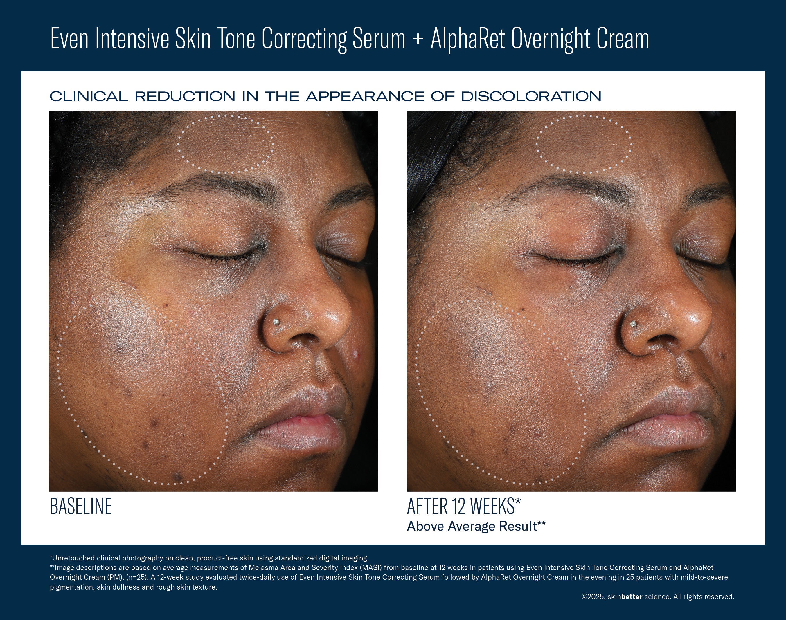 SkinBetter Science Even Intensive Skin Tone Correcting Serum (1.7 oz).
