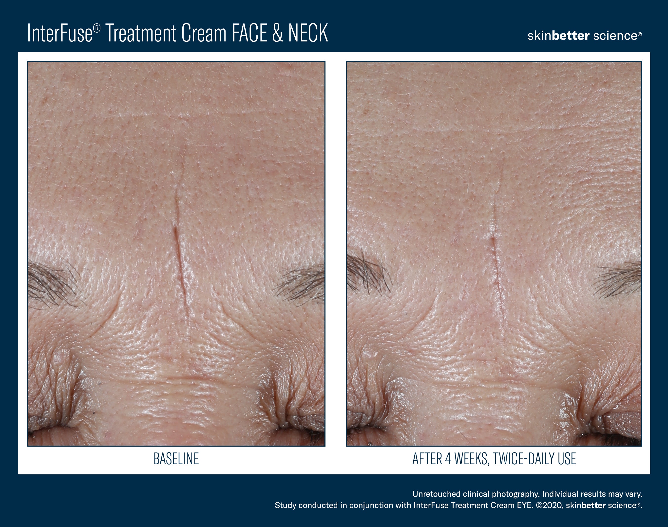SkinBetter Science InterFuse Treatment Cream Face & Neck (1.69 oz).
