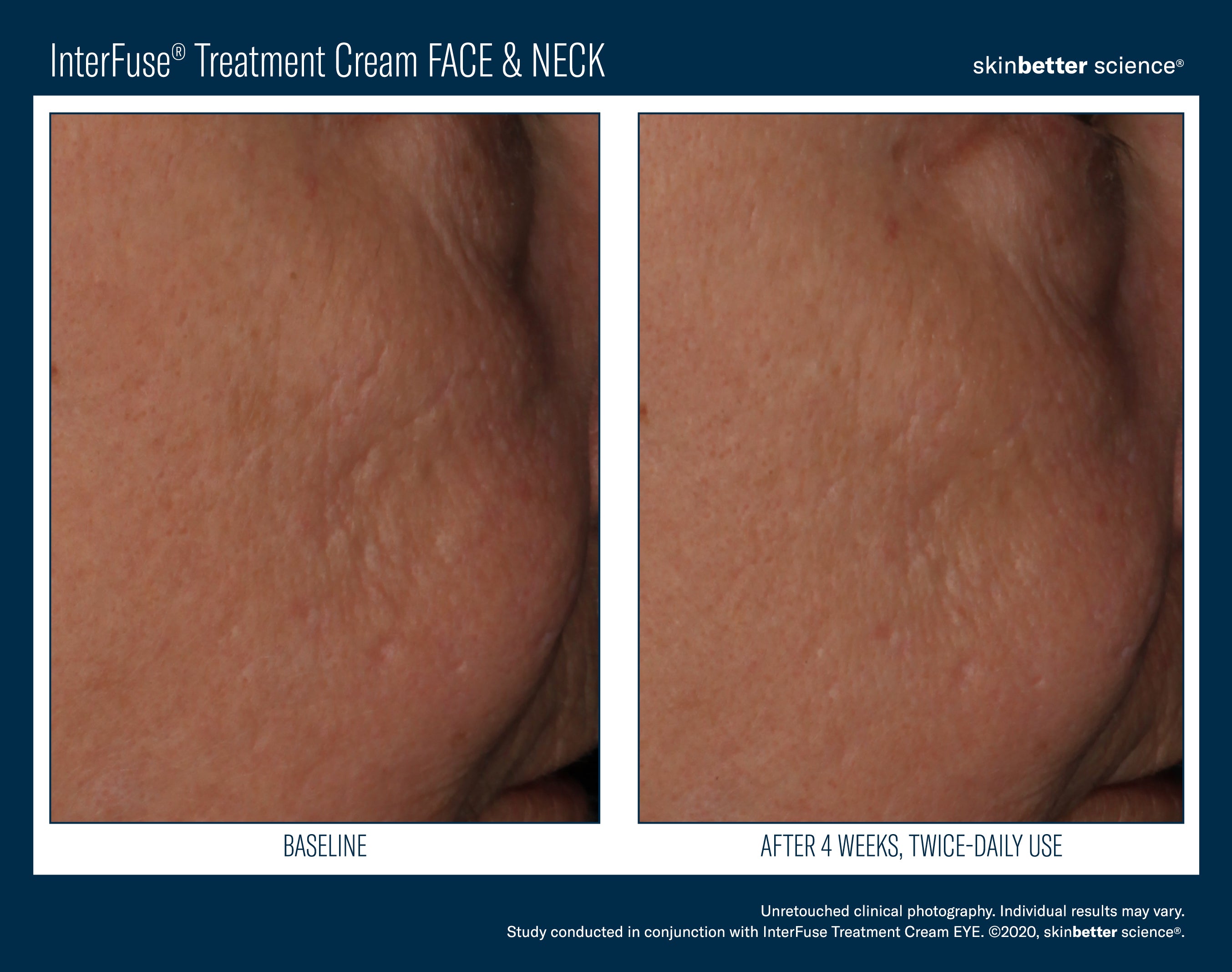 SkinBetter Science InterFuse Treatment Cream Face & Neck (1.69 oz).