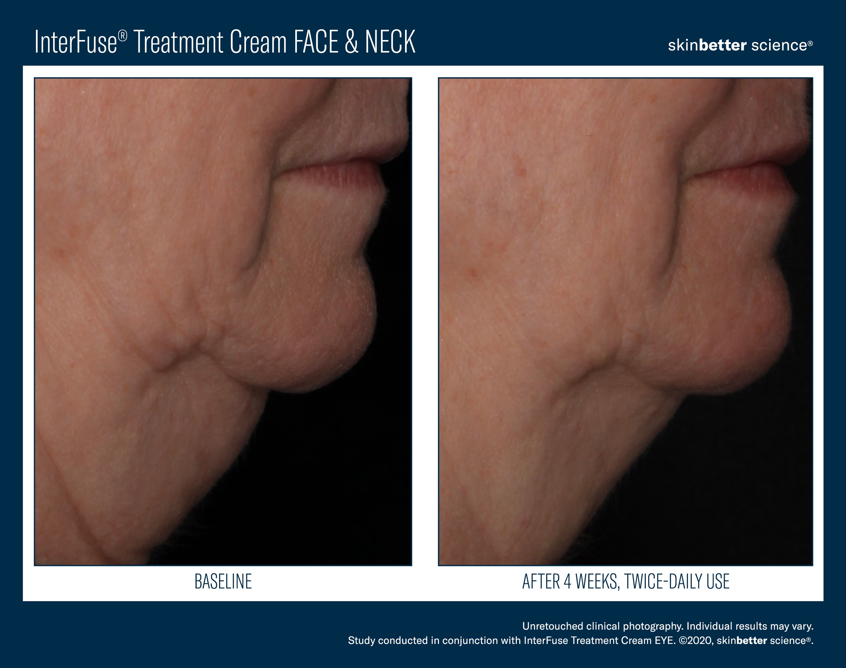 SkinBetter Science InterFuse Treatment Cream Face & Neck (1.69 oz).