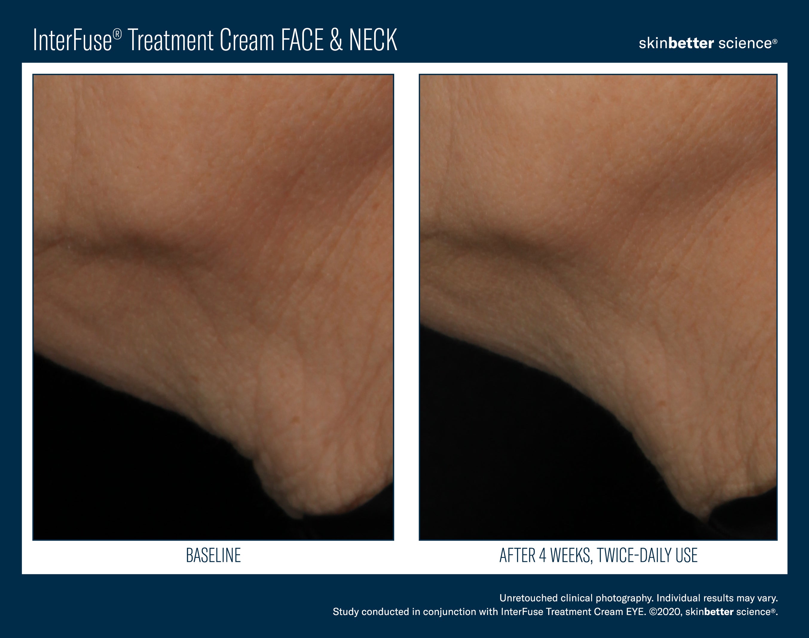 SkinBetter Science InterFuse Treatment Cream Face & Neck (1 oz).