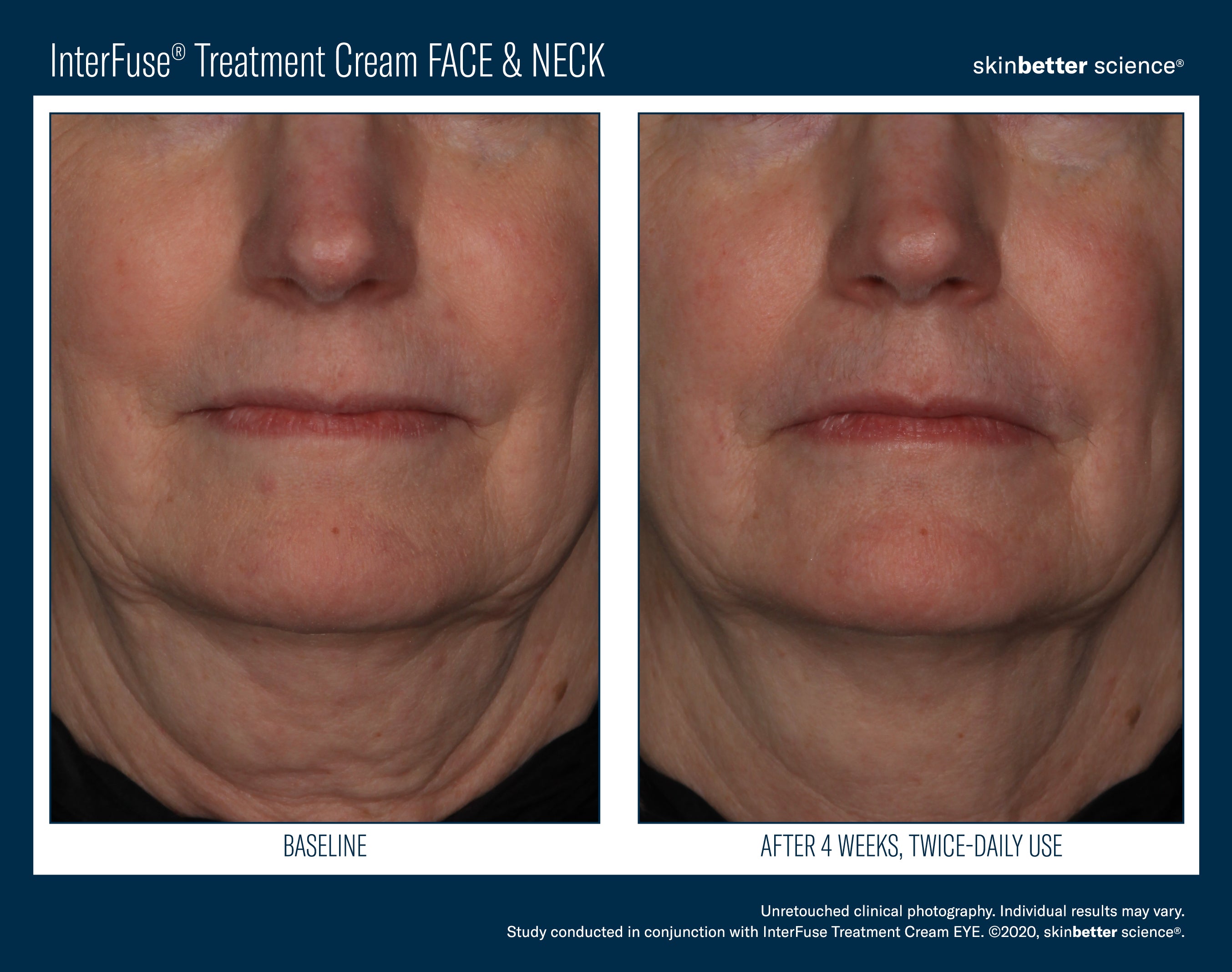 SkinBetter Science InterFuse Treatment Cream Face & Neck (1 oz).