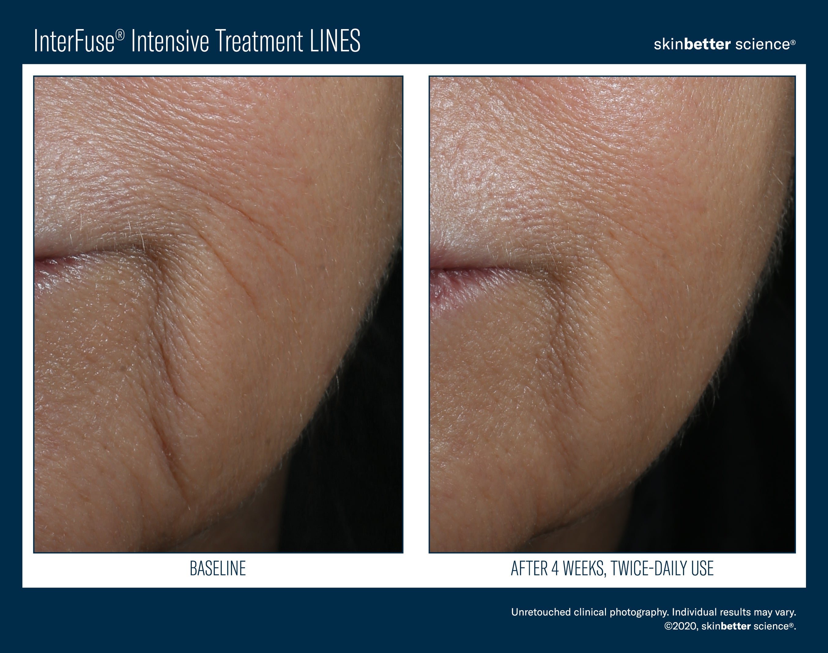 SkinBetter Science InterFuse Intensive Treatment Lines (1 oz).