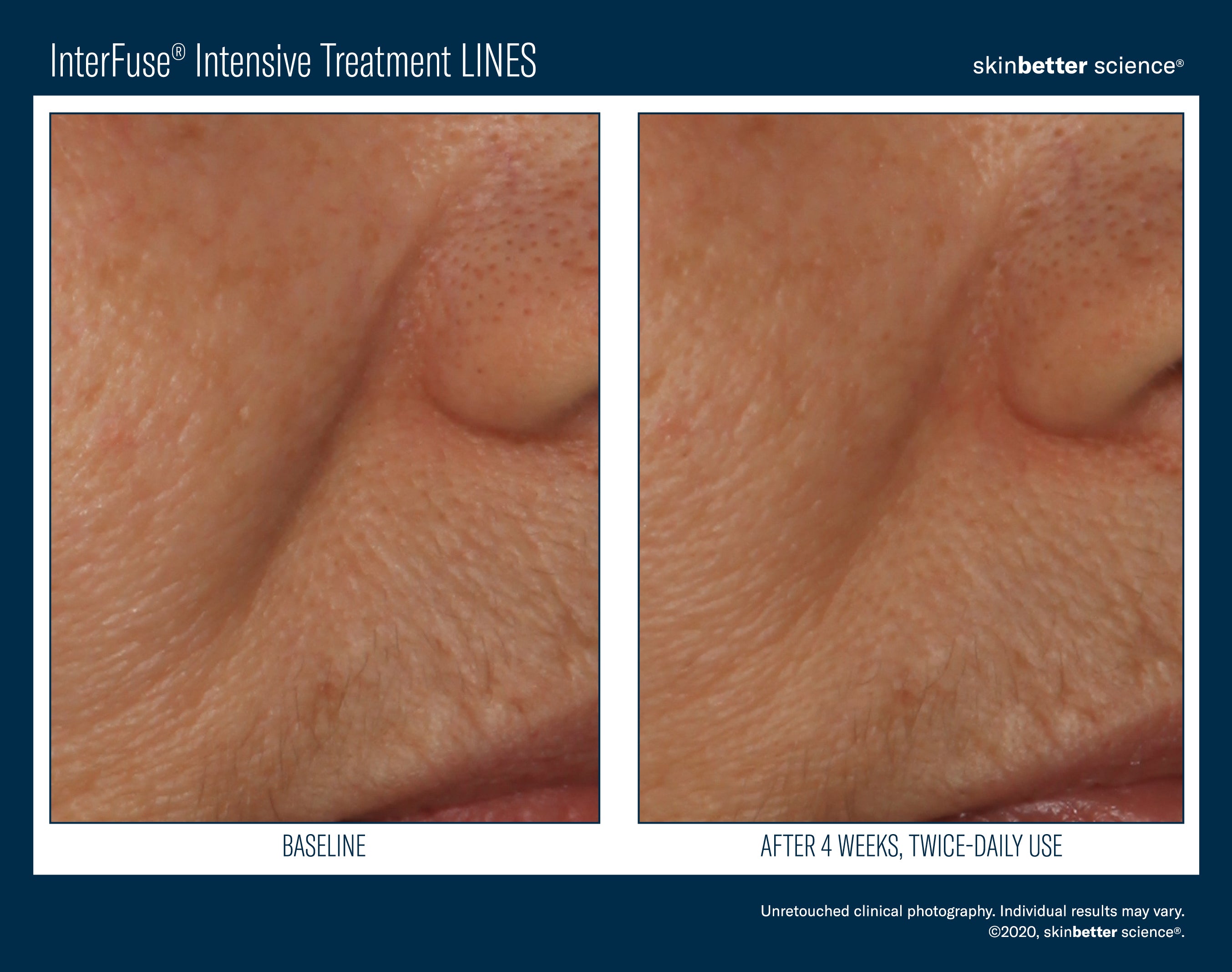 SkinBetter Science InterFuse Intensive Treatment Lines (1 oz).