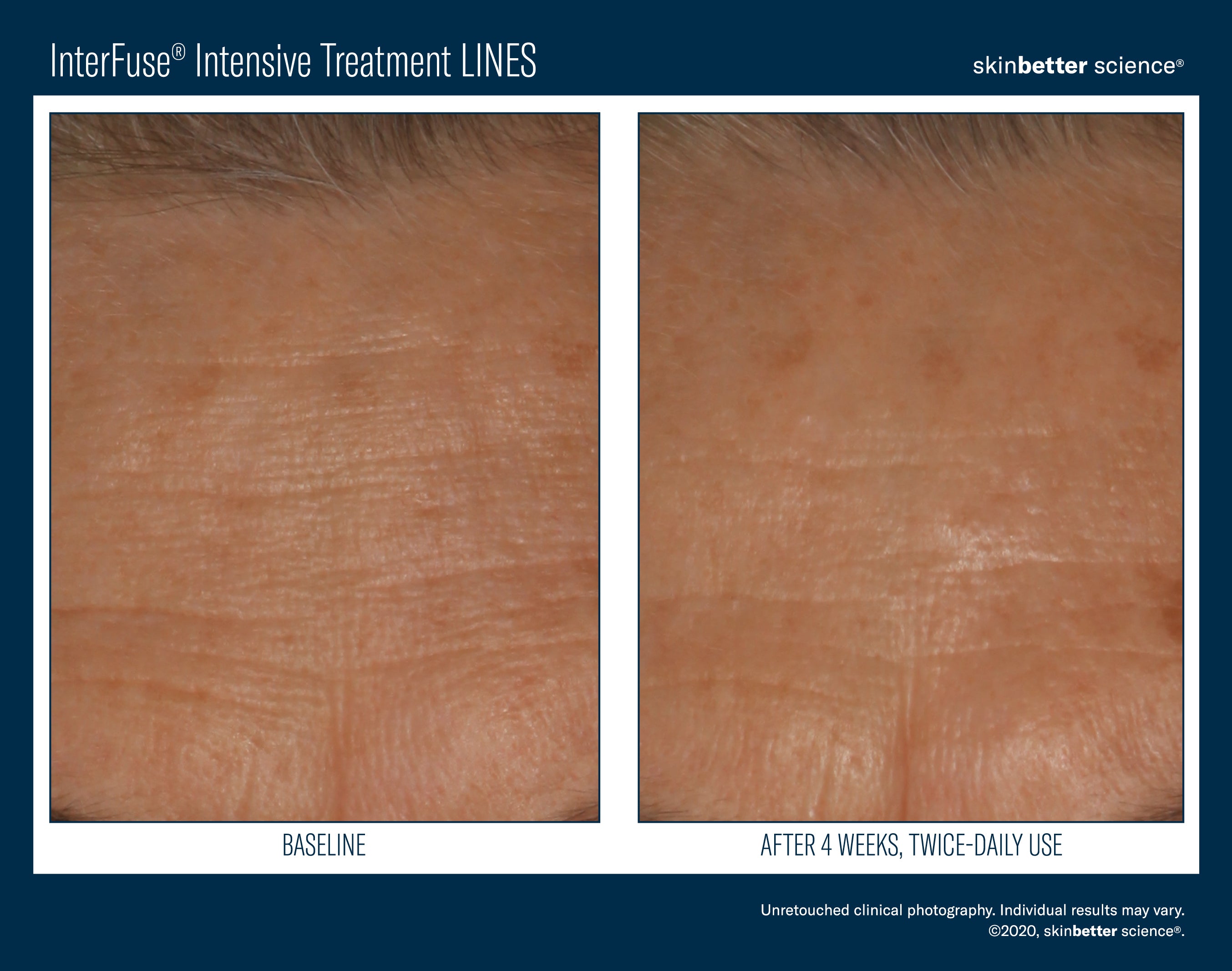 SkinBetter Science InterFuse Intensive Treatment Lines (1 oz).