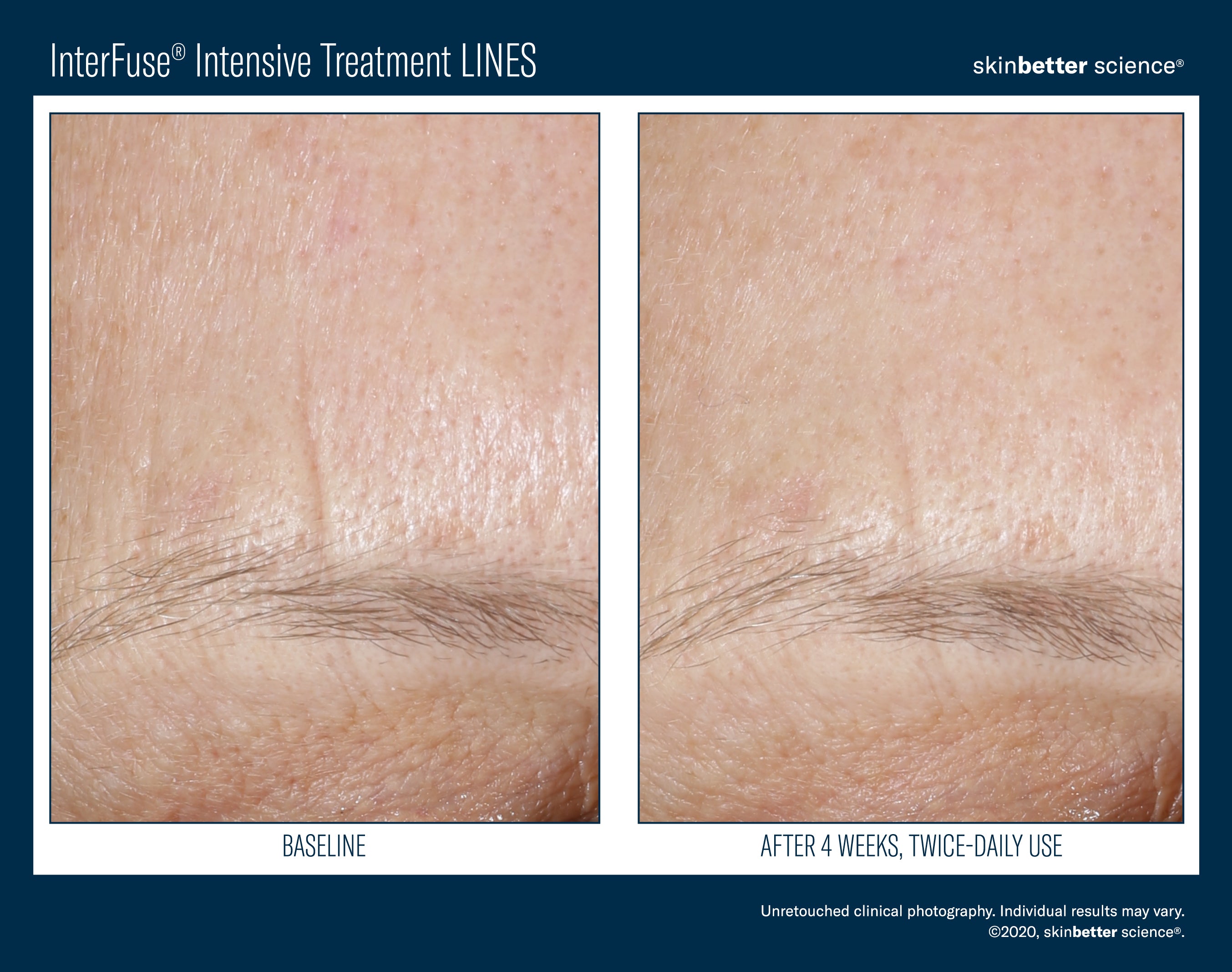 SkinBetter Science InterFuse Intensive Treatment Lines (1 oz).