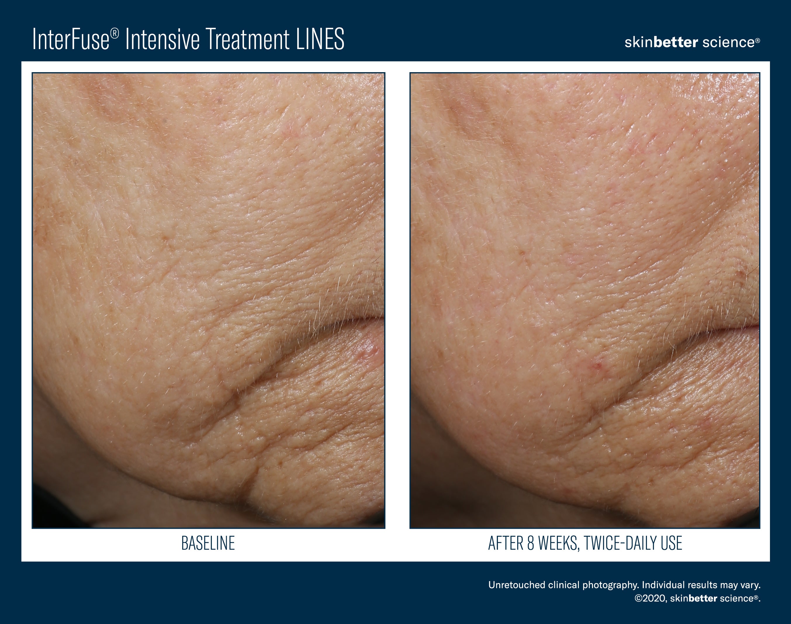 SkinBetter Science InterFuse Intensive Treatment Lines (1 oz).