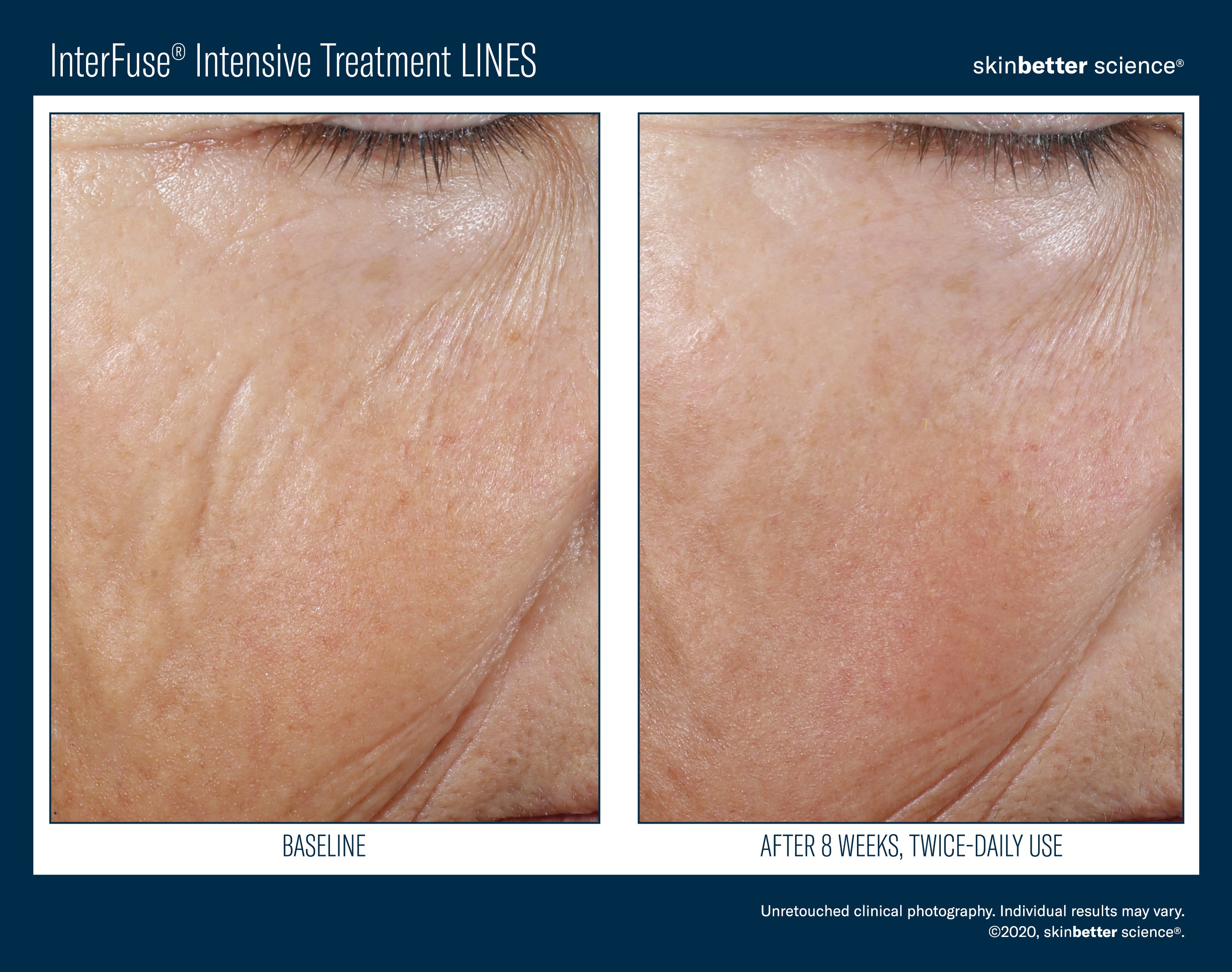 SkinBetter Science InterFuse Intensive Treatment Lines (1 oz).
