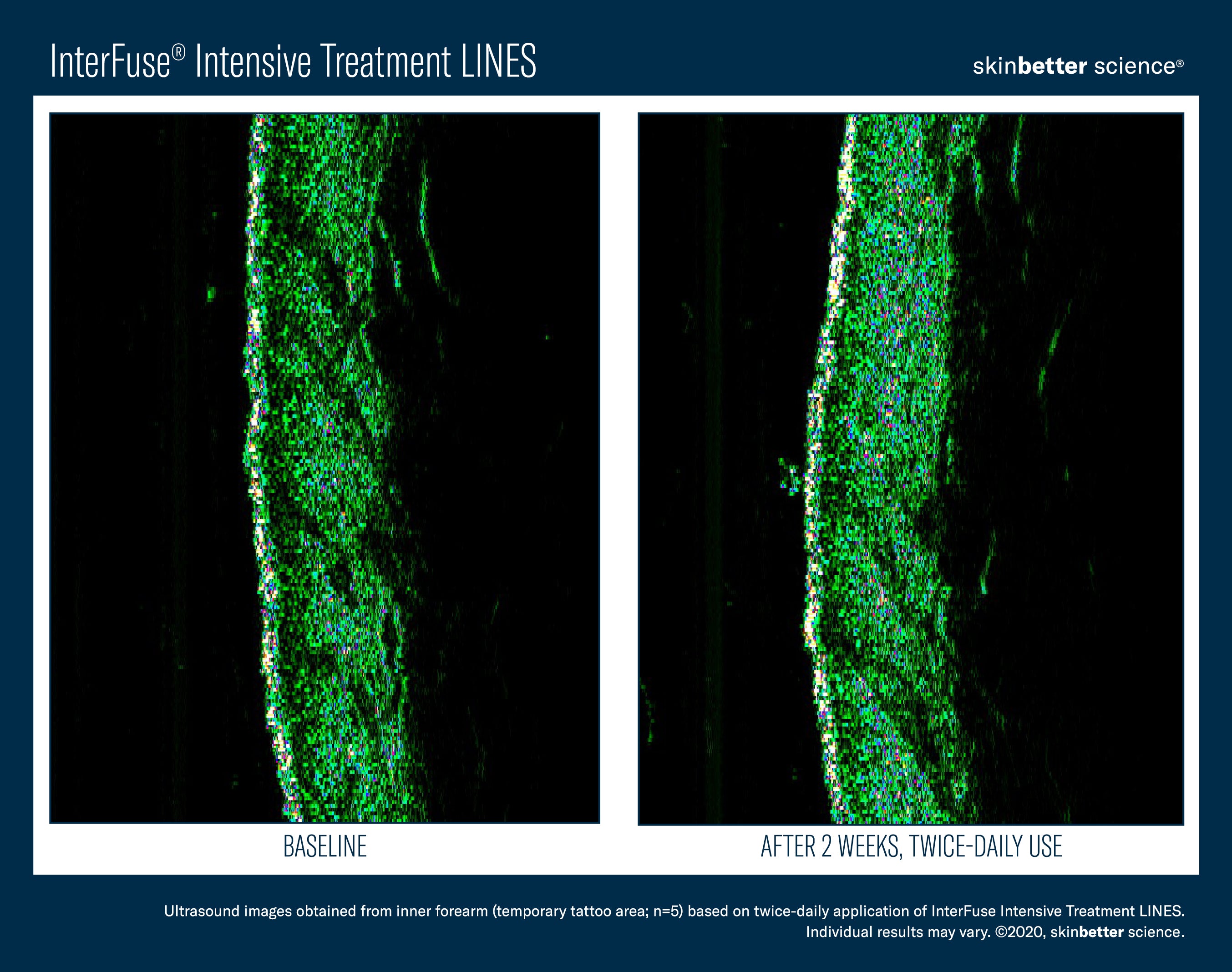 SkinBetter Science InterFuse Intensive Treatment Lines (1 oz).