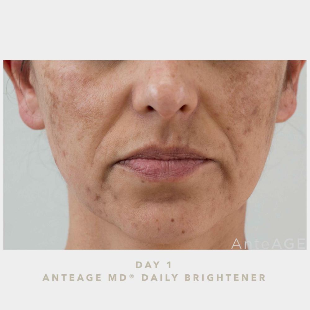 AnteAGE MD Biosome Brightener (1 oz)