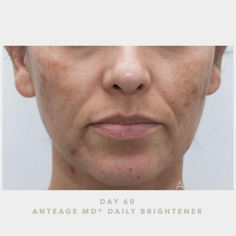 AnteAGE MD Biosome Brightener (1 oz)