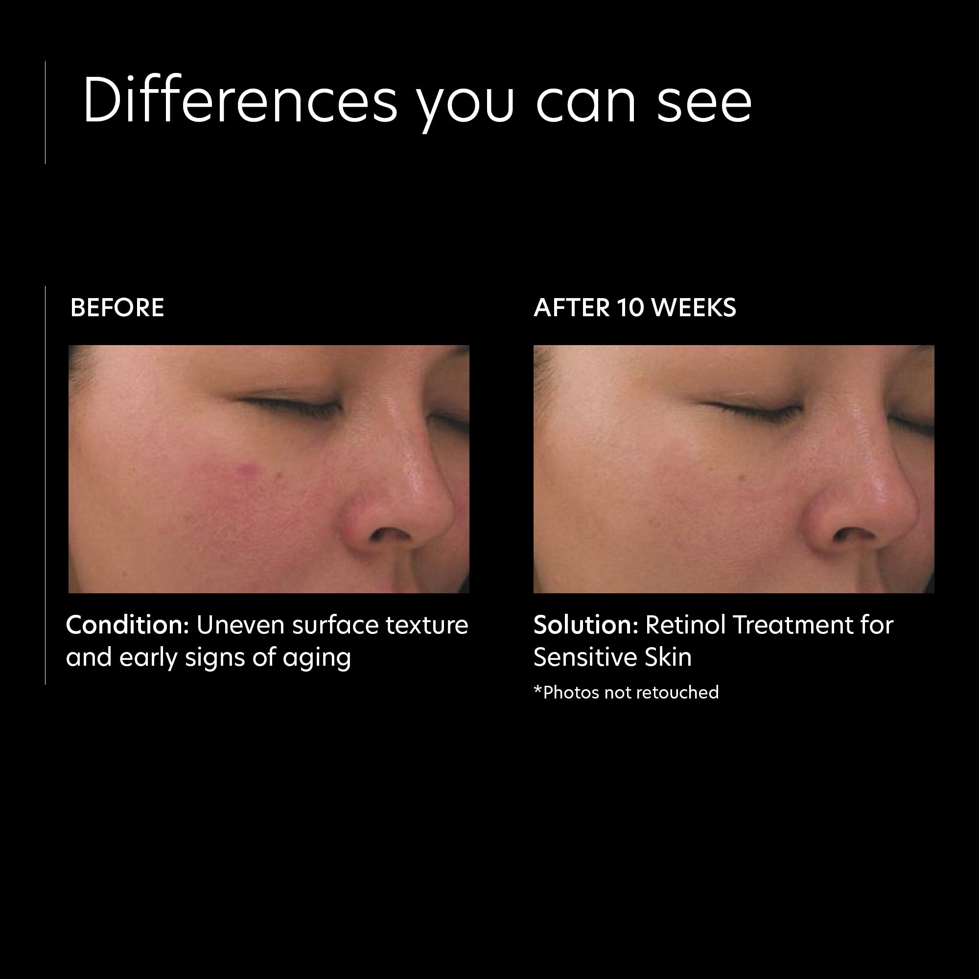 PCA Skin Retinol Treatment for Sensitive Skin (1 oz).