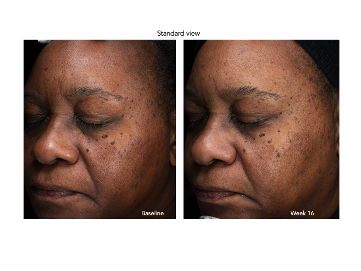 Senté Pigment & Tone Correcting Mask Cysteamine HSA (1.69 oz).