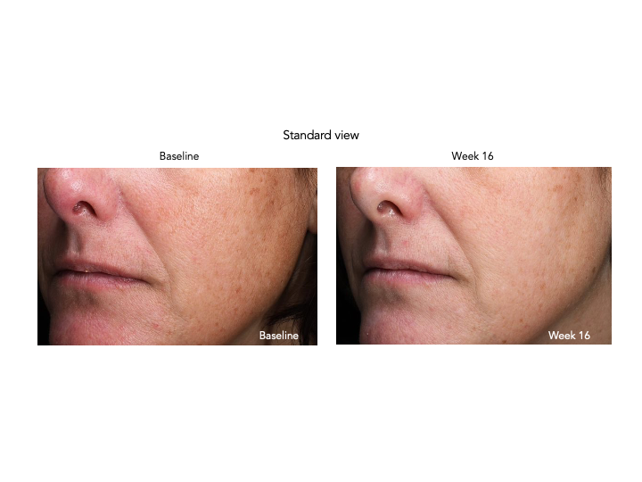Senté Pigment & Tone Correcting Mask Cysteamine HSA (1.69 oz).